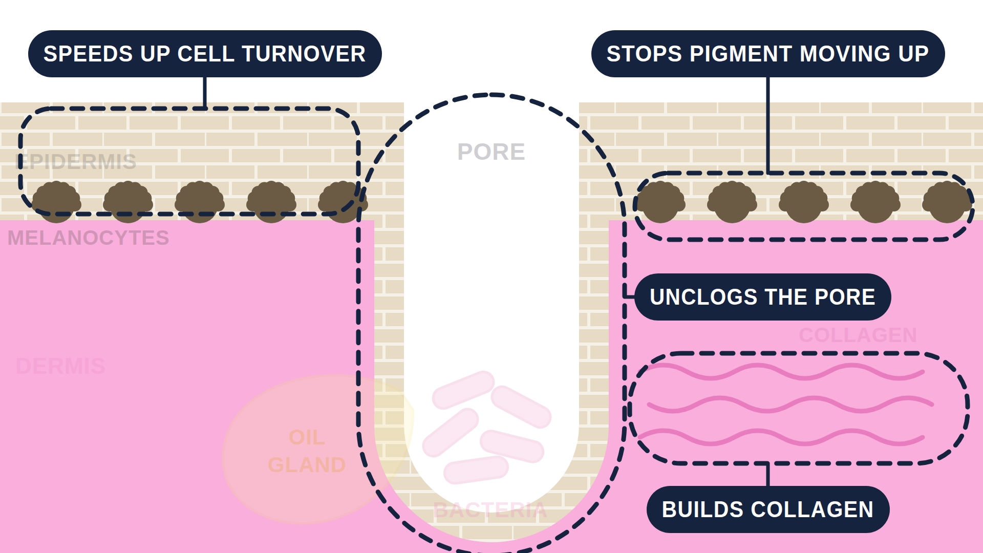 Labeled cutaway diagram of a single skin pore, headed Adapalene. The epidermis is a brick-textured band across the top and the dermis is pink below it, with a yellow oil gland at the base of the pore and a small cluster of bacteria inside it. Three callout lines point in: decreases dead cells in pore and decreases oil production are drawn in dark navy as main effects, and decreases inflammation is drawn in gray as a lesser one.