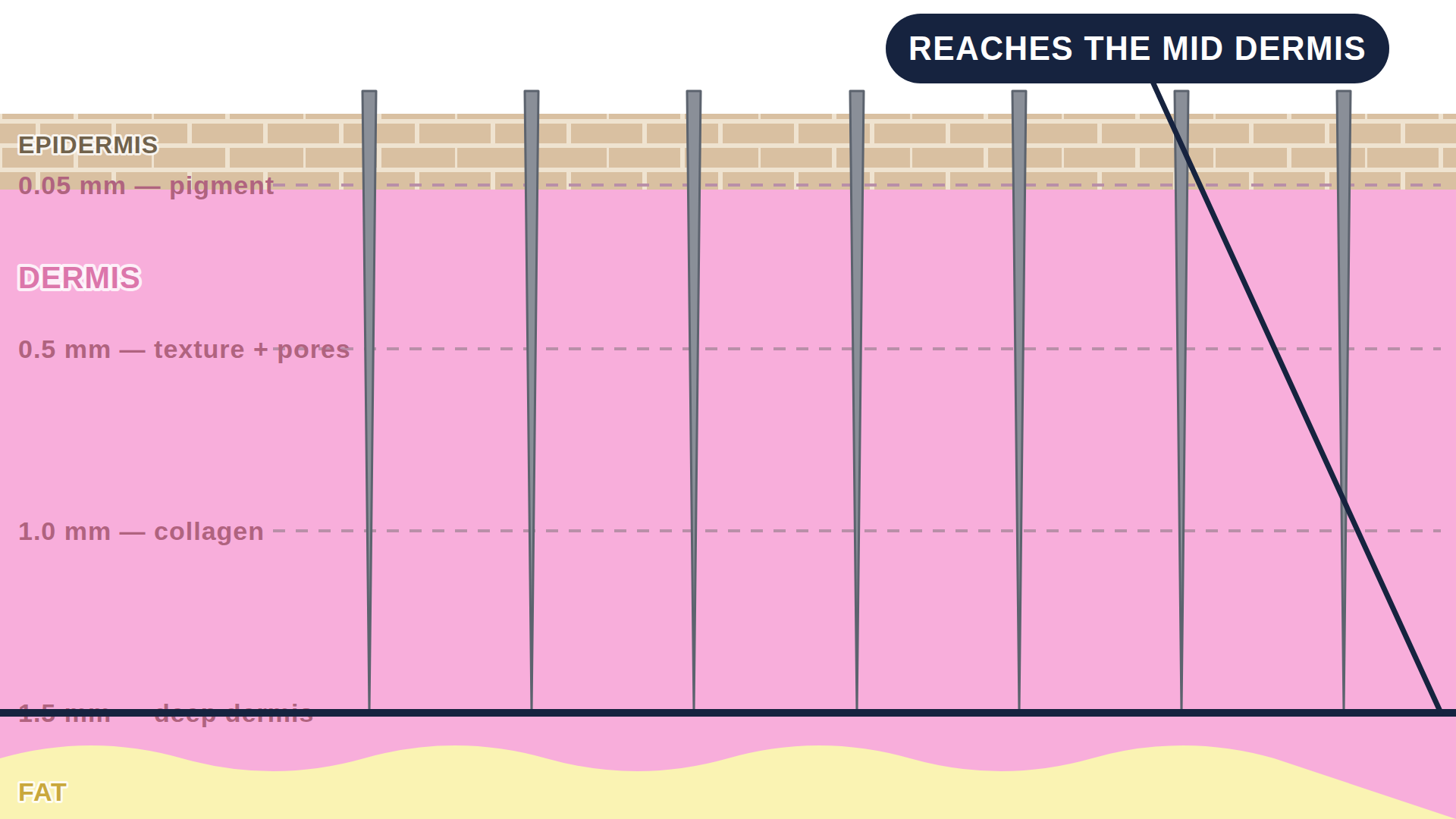 Diagram: how Microneedling works in the skin