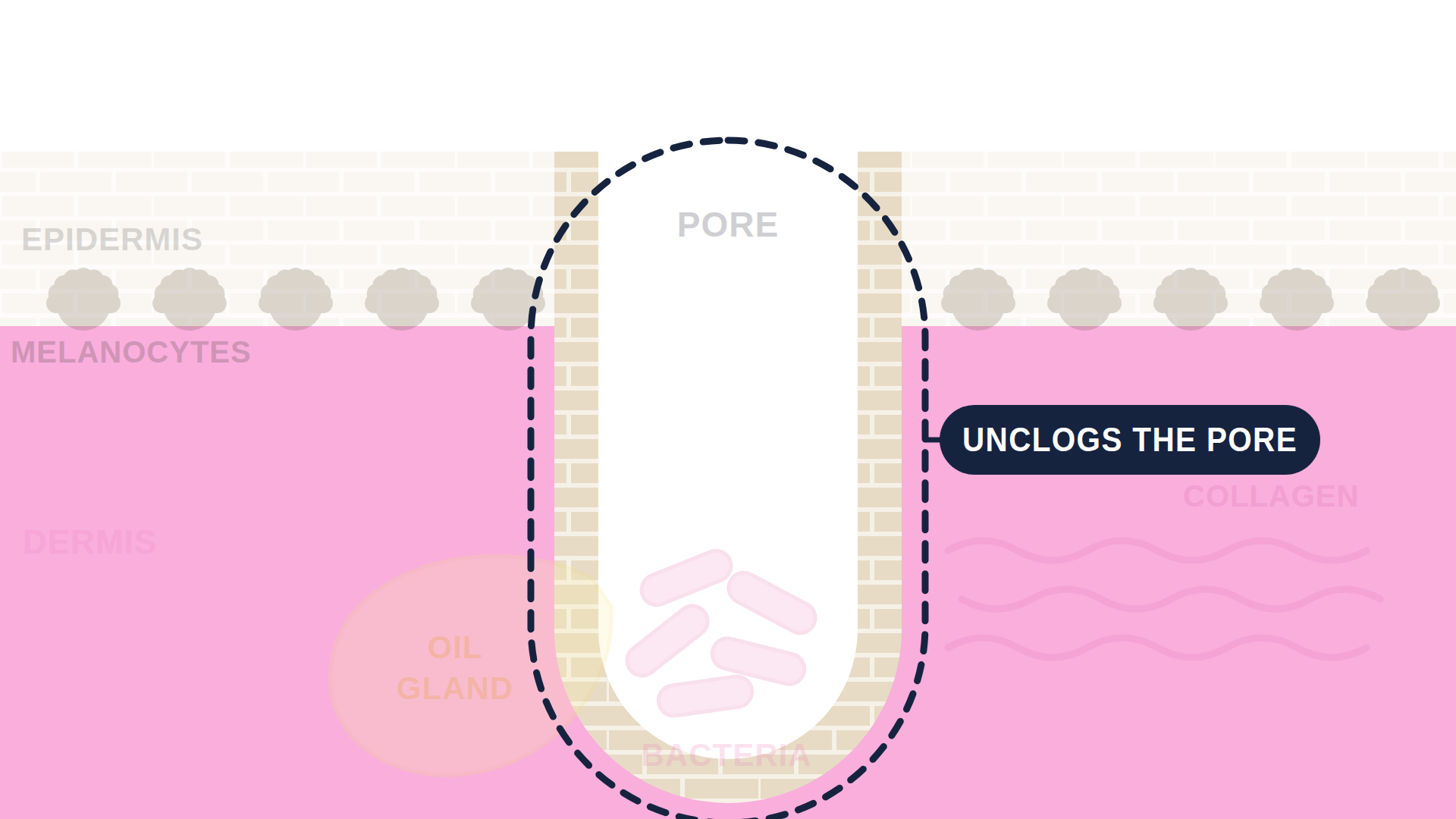 Labeled cutaway diagram of a single skin pore, headed Salicylic Acid. The epidermis is a brick-textured band across the top and the dermis is pink below it, with a yellow oil gland at the base of the pore and a small cluster of bacteria inside it. A single dark navy callout line points into the top of the pore: decreases dead cells in pore. There are no other callouts, so the drawing shows one effect where the other ingredient diagrams show two or three.
