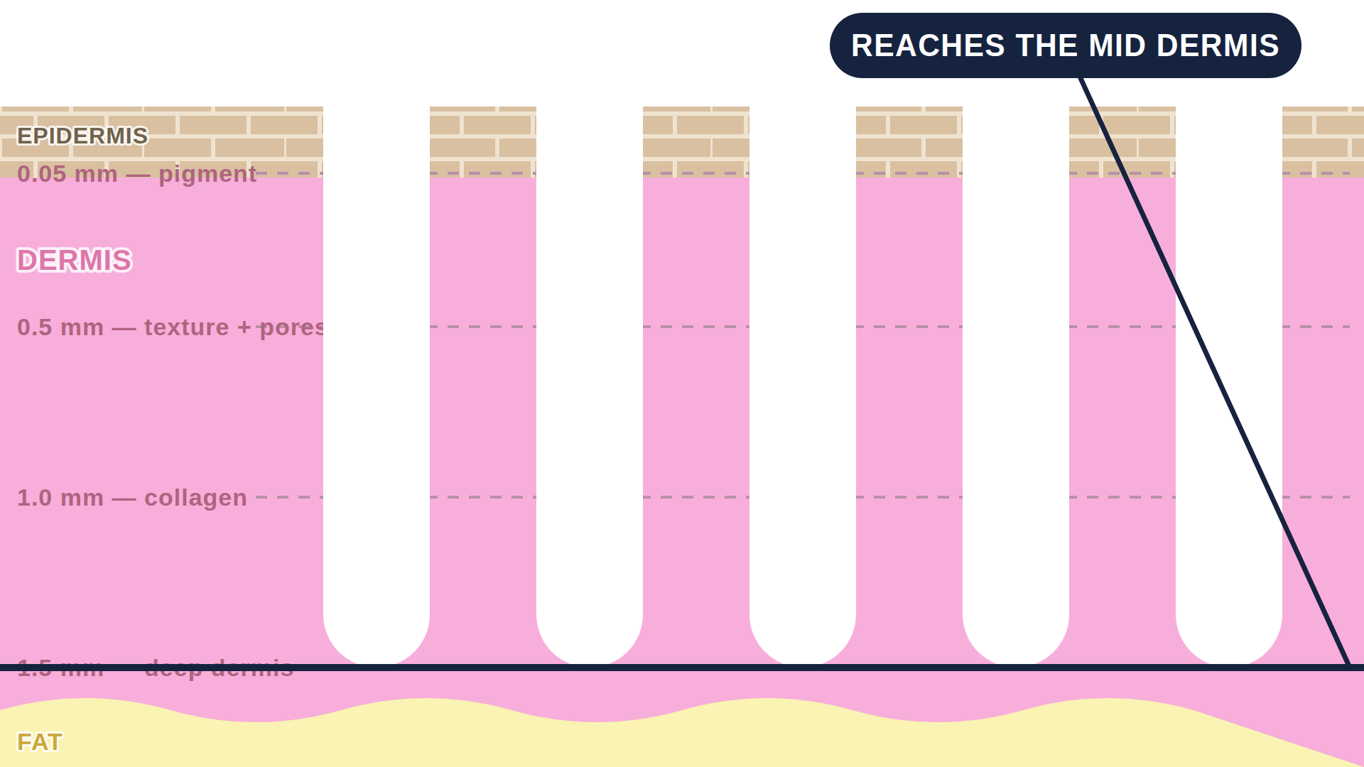 Diagram: how Fractional CO2 Laser works in the skin