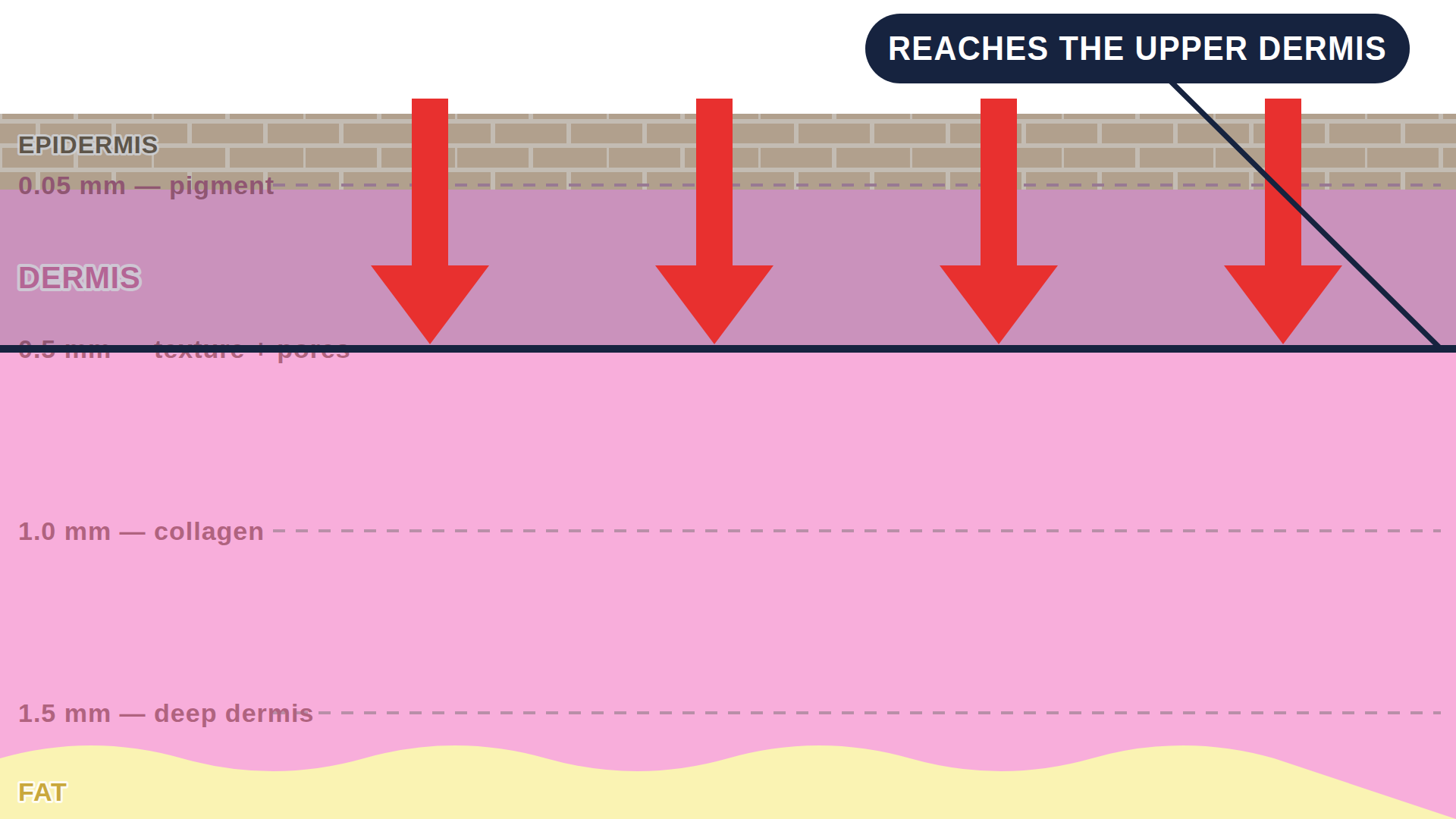 Diagram: how TCA Peel works in the skin