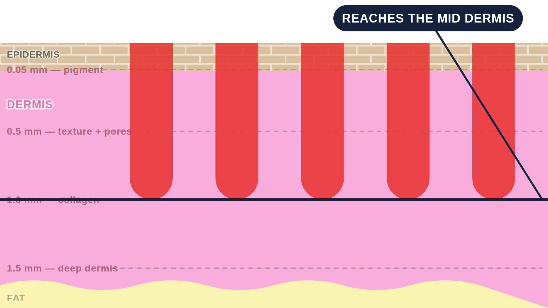 Diagram: how Fraxel works in the skin