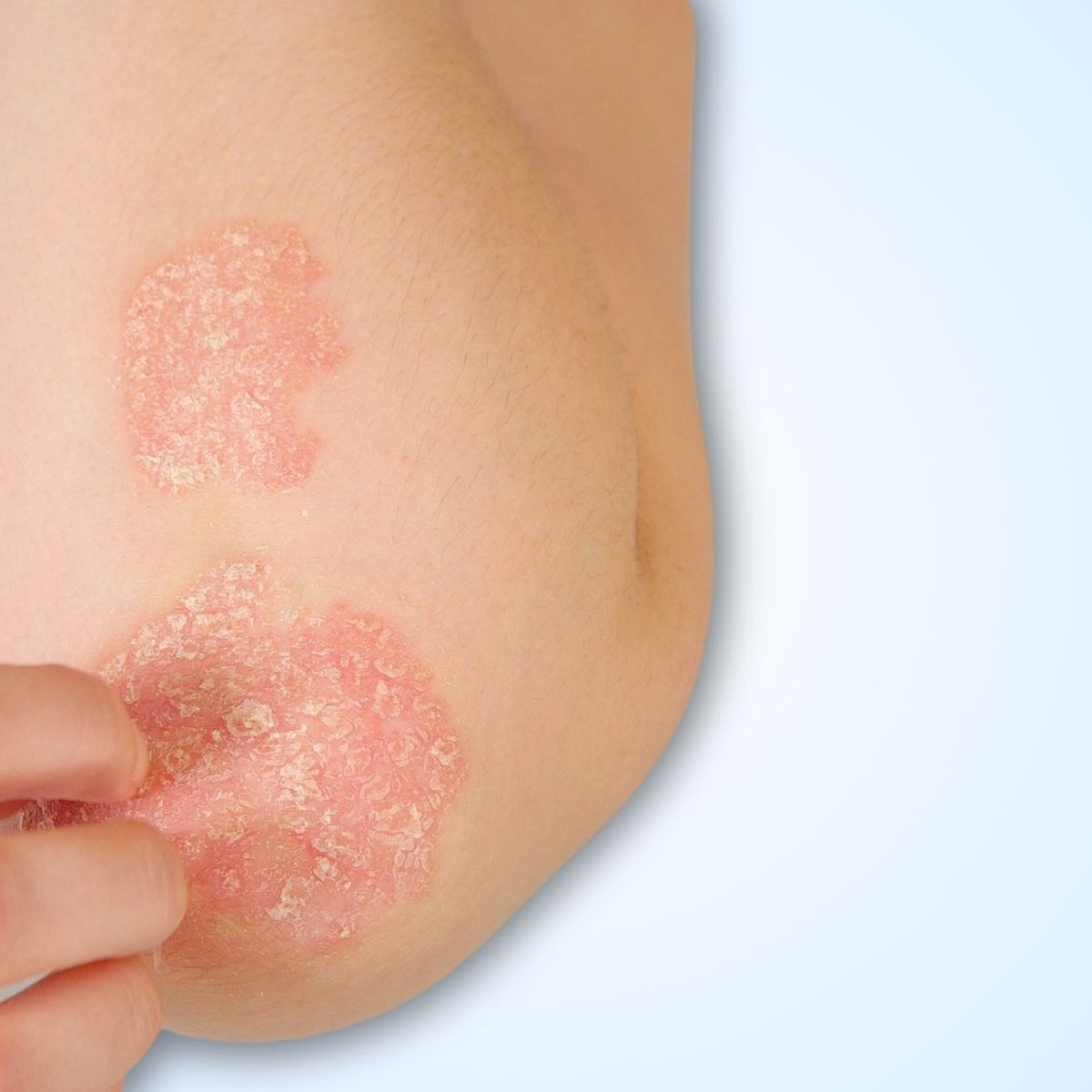 Psoriasis guide