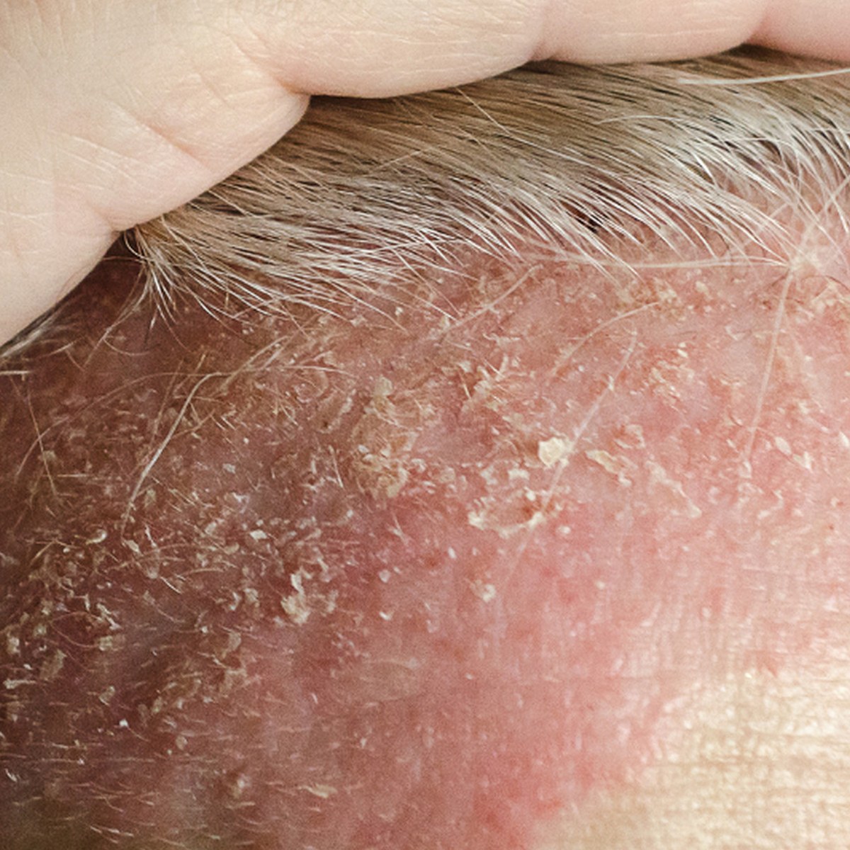 Scalp Psoriasis guide