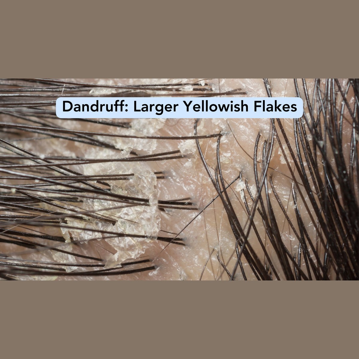 Dandruff guide