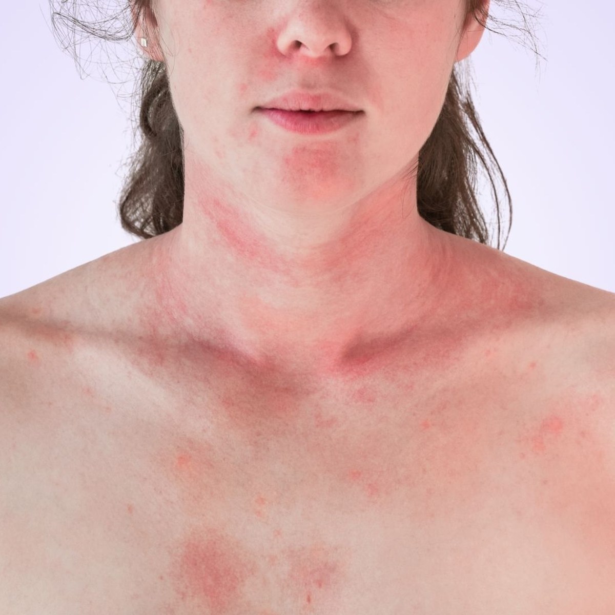 Eczema guide