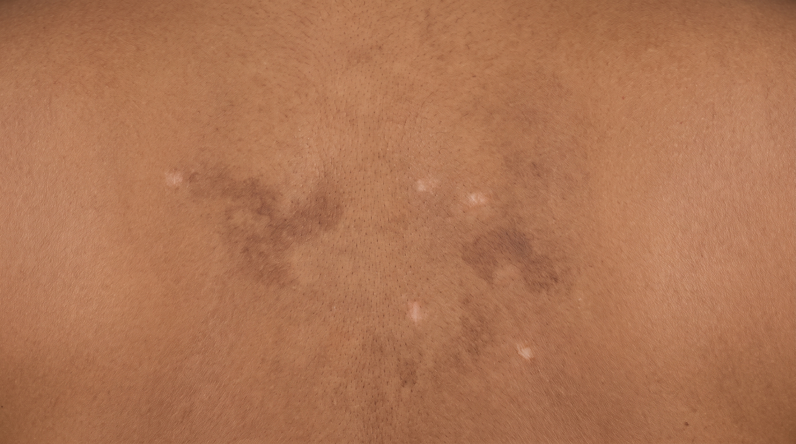 Flat brown and pale patches on a forearm where eczema has settled, the skin surface smooth again but the color still uneven.