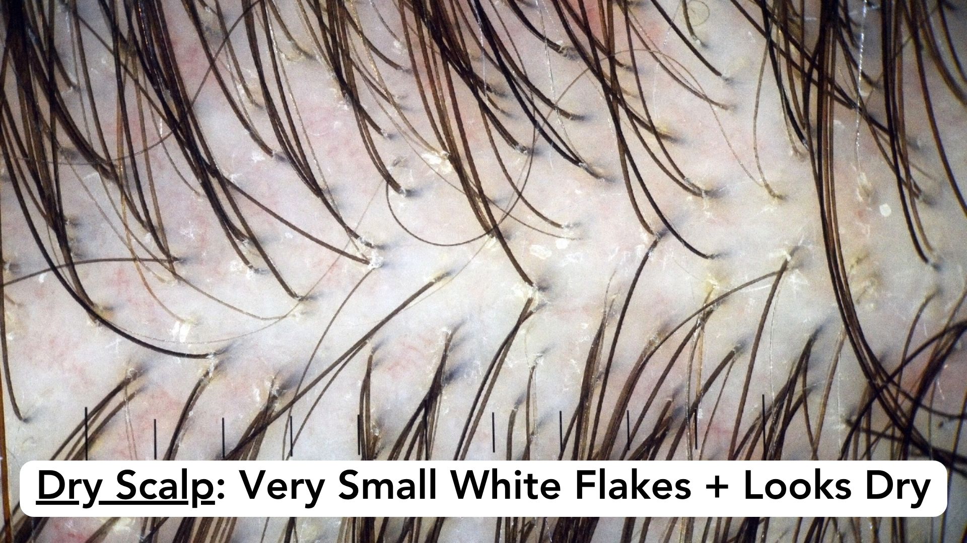 Close-up of a pale scalp between brown hairs, dusted with very small loose white flakes on dry-looking skin.