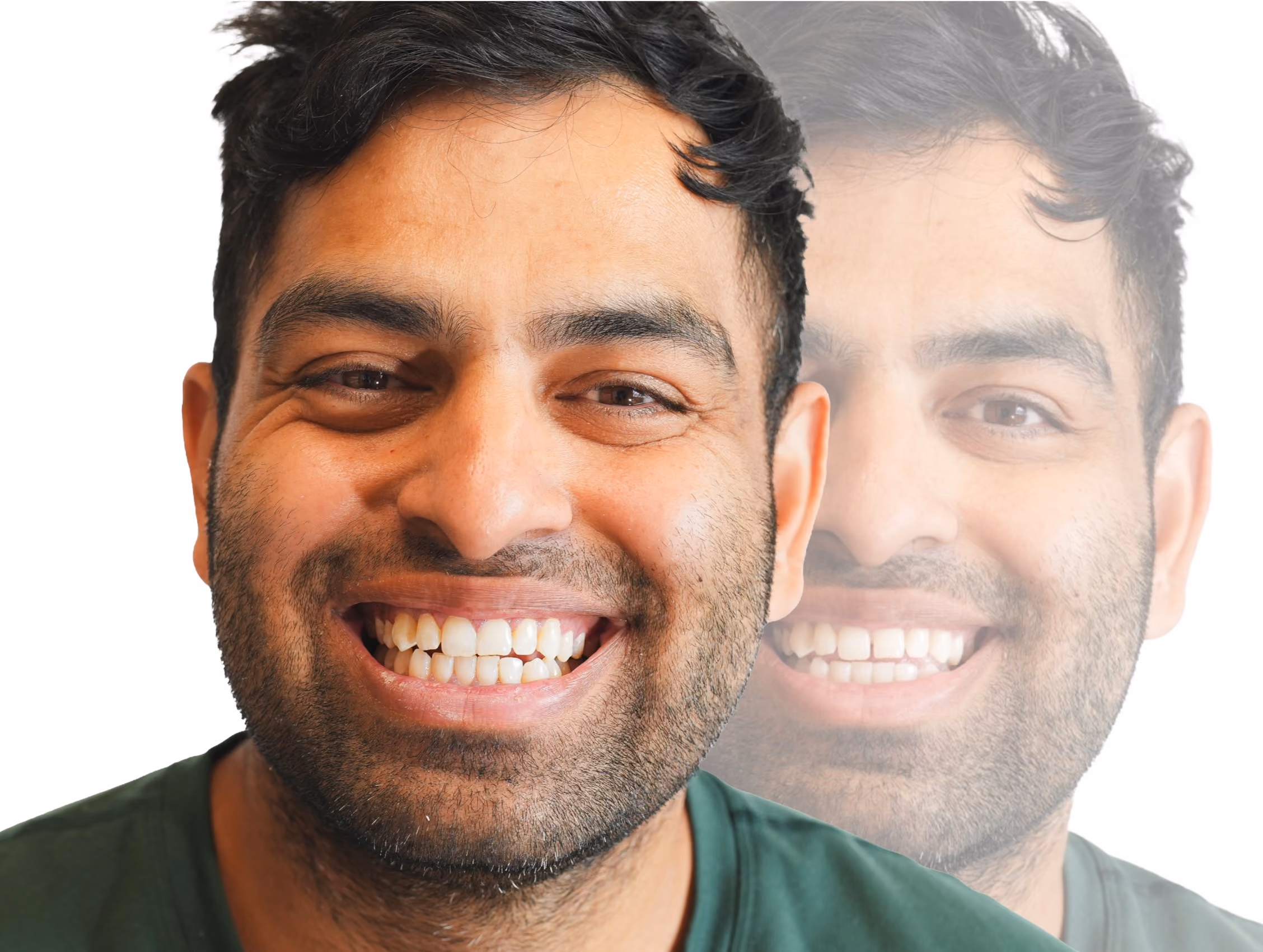 The upper front teeth after composite bonding closed the gap in a single visit. Individual results vary.