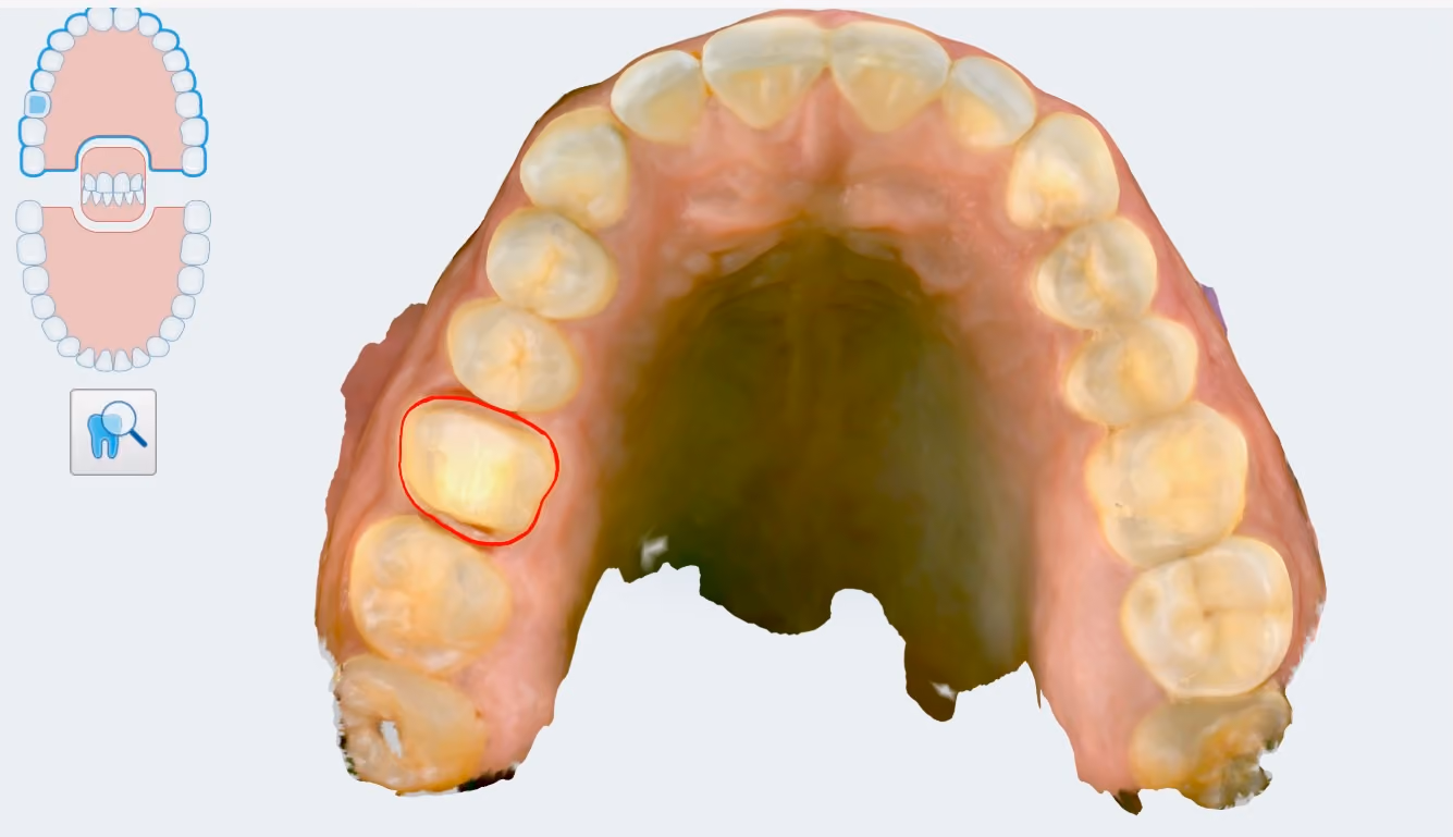 Digital dental scan used to plan the diastema closure and assess the bite