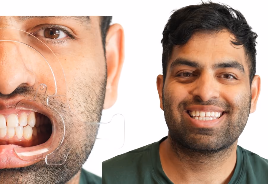 Front teeth with a diastema (gap between the front teeth) before composite bonding, retracted view