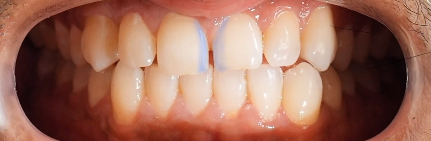 Etching gel applied to the front teeth to prepare the enamel for bonding