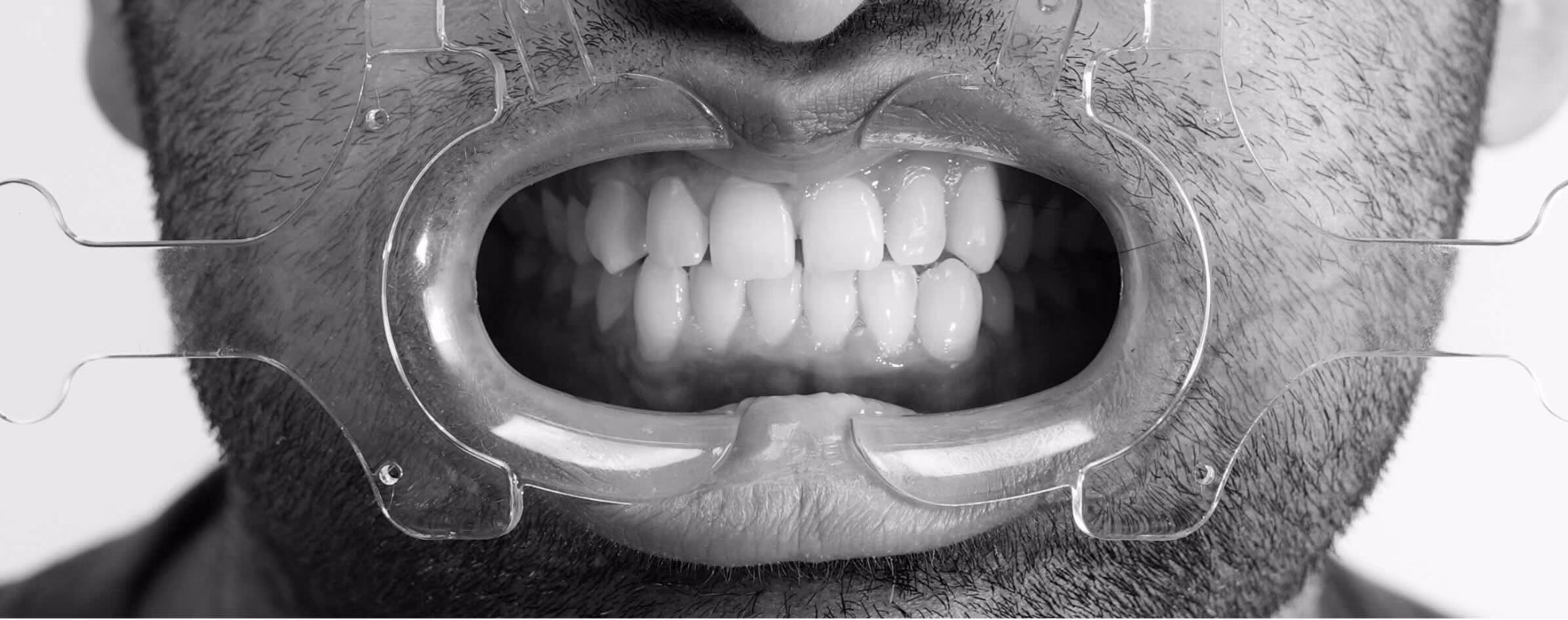 Black and white photo of front teeth used to map light reflection and texture during smile design