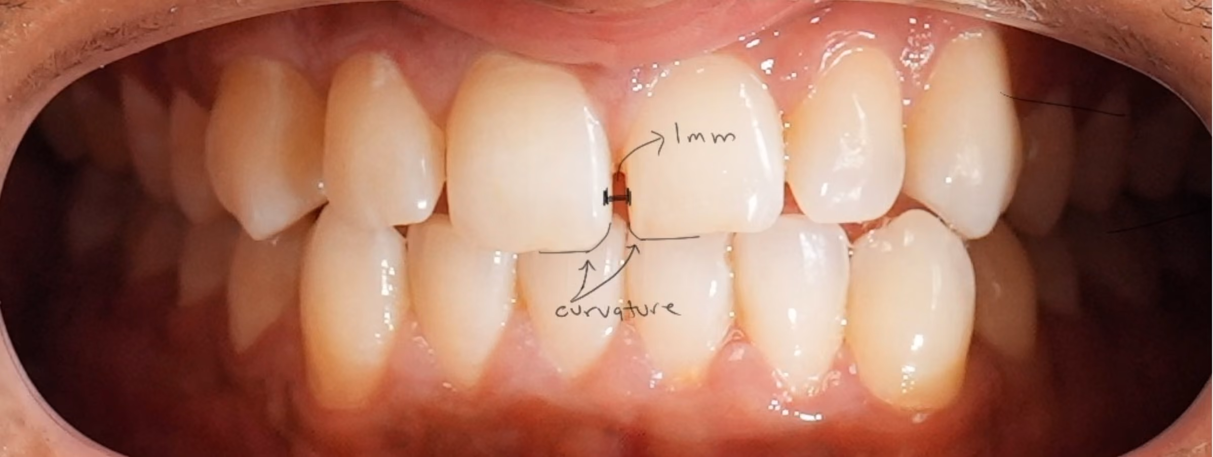 Measuring the front tooth gap and edge curvature before composite bonding