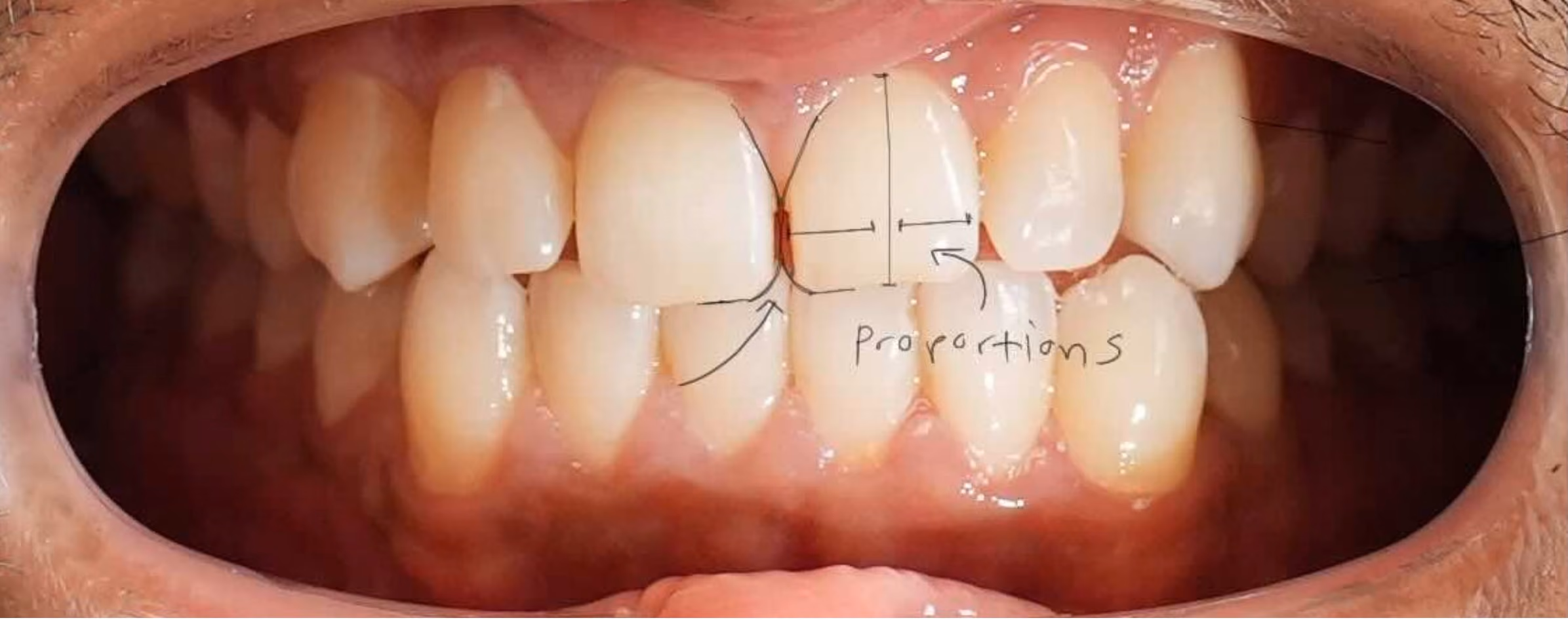 Smile design markings showing tooth proportions before closing the front tooth gap