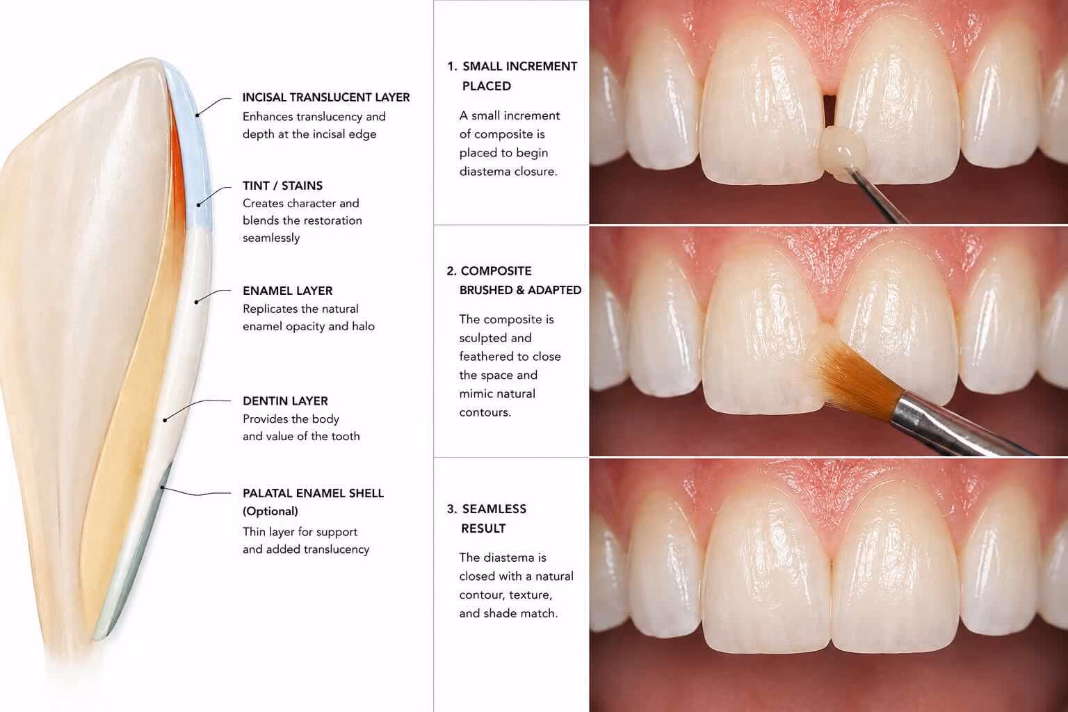 Diagram of the composite layering technique used for diastema closure