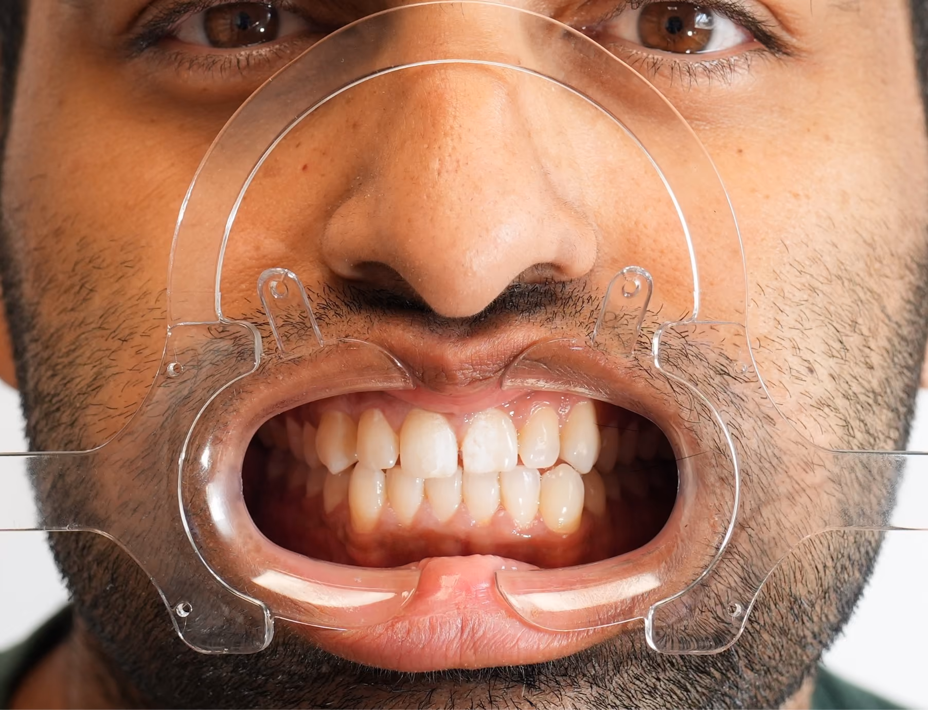 Front teeth isolated with a rubber dam showing the chalky enamel surface after air abrasion