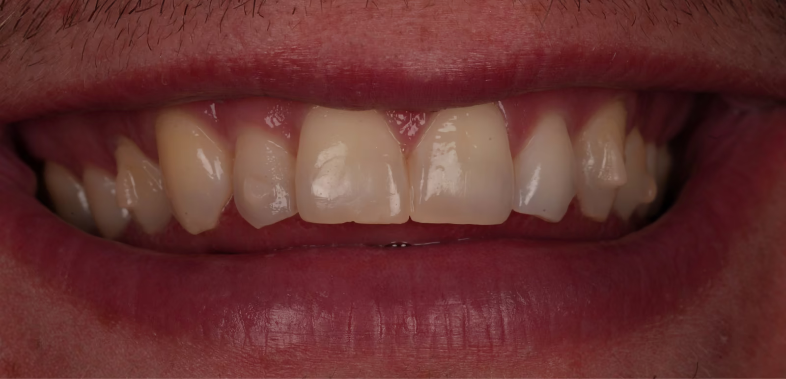 Front view of the smile at two months of clear aligner treatment.