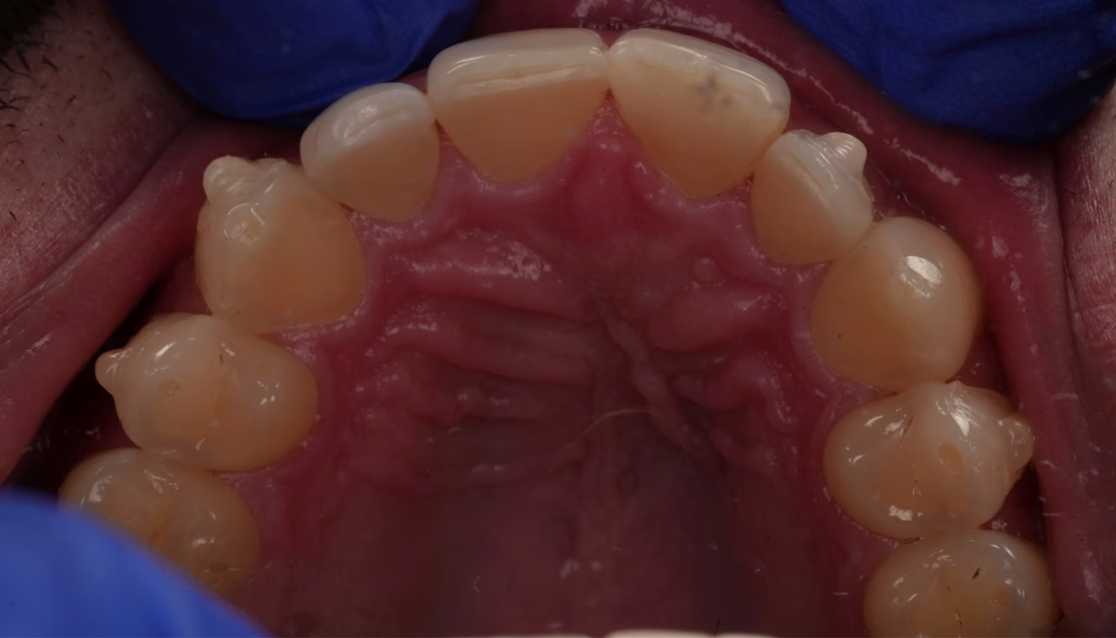 Occlusal view of the upper arch at two months of aligner treatment showing progressive alignment.