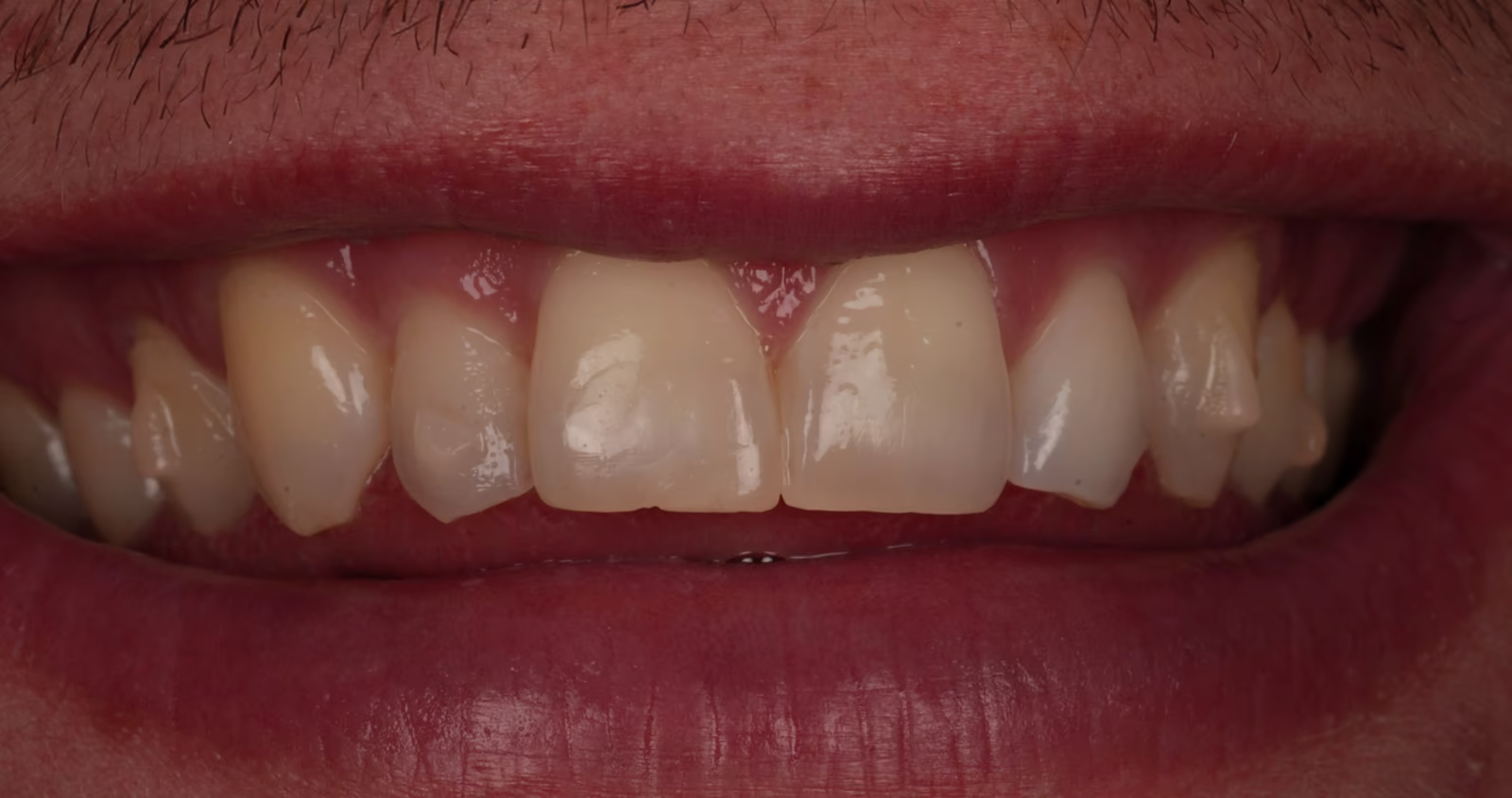 Front view of the upper teeth early in clear aligner treatment, with the lateral incisors sitting behind the arch.