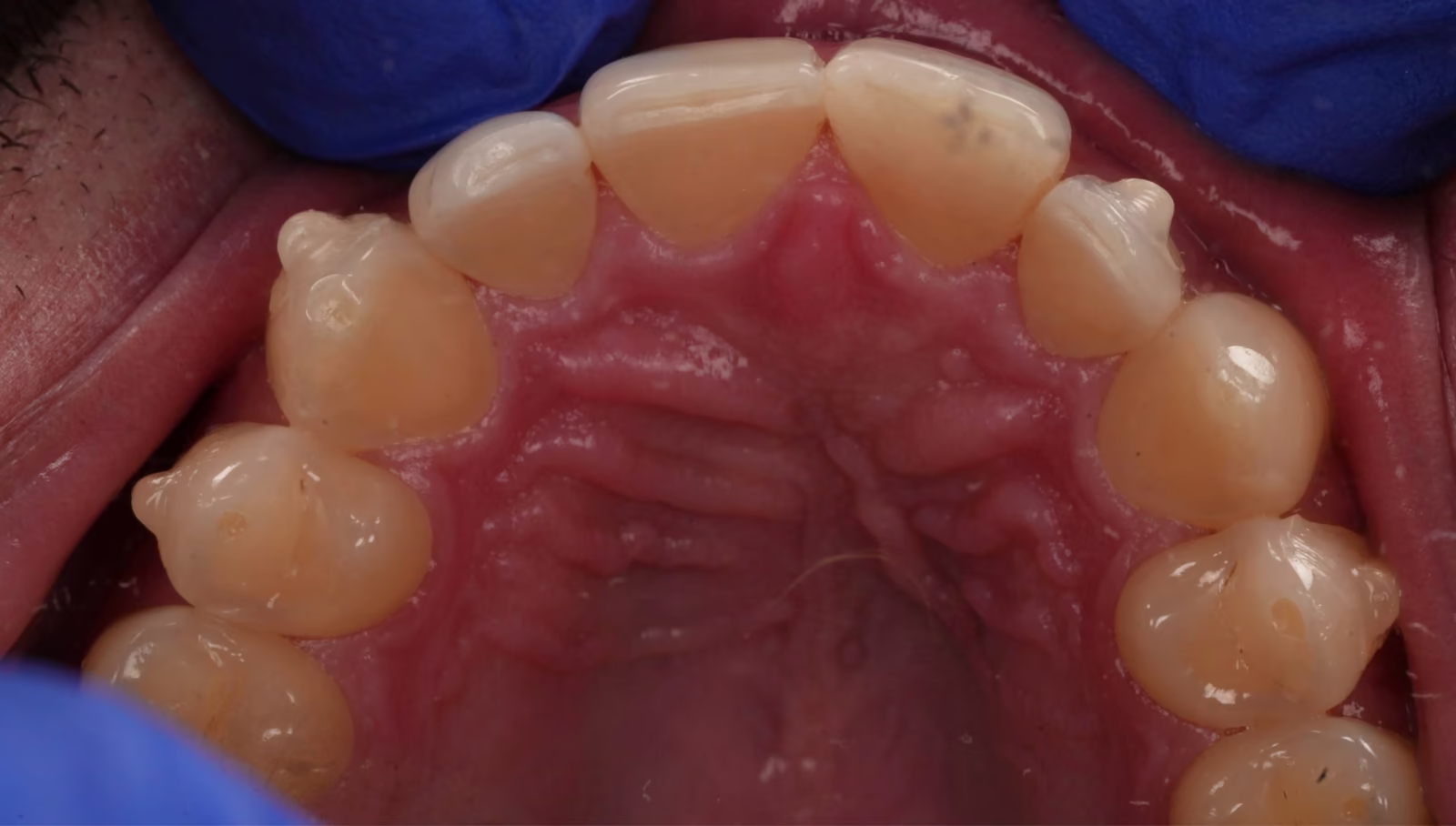 Occlusal view of the upper arch at one month of aligner treatment with composite attachments in place.