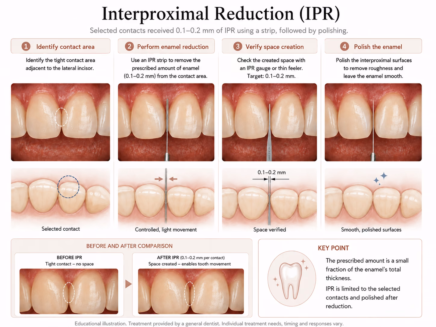 Diagram of interproximal reduction: removing a fraction of a millimetre of enamel at a contact point, then polishing.