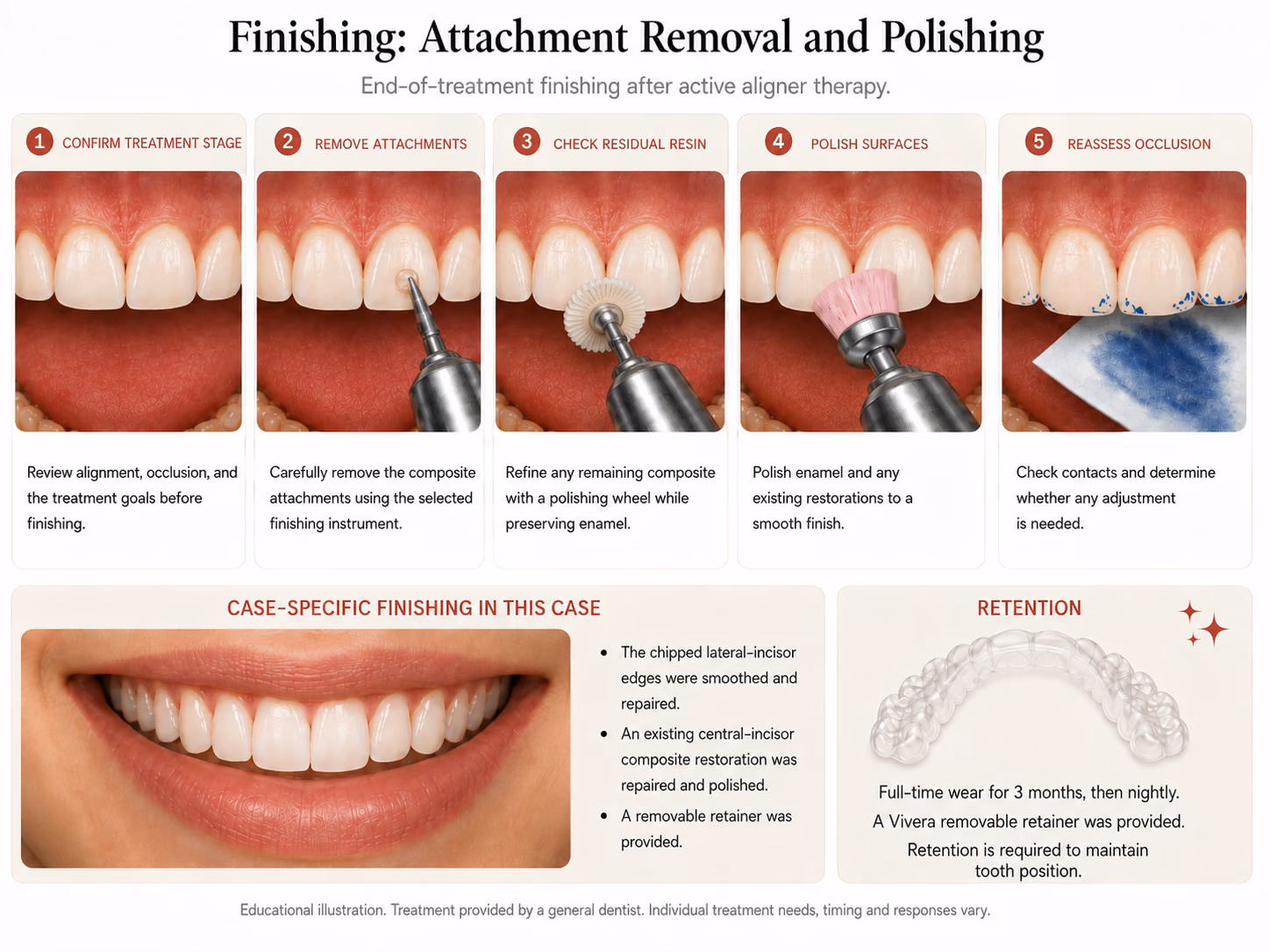 Diagram of end-of-treatment finishing: composite attachment removal, polishing and retention.