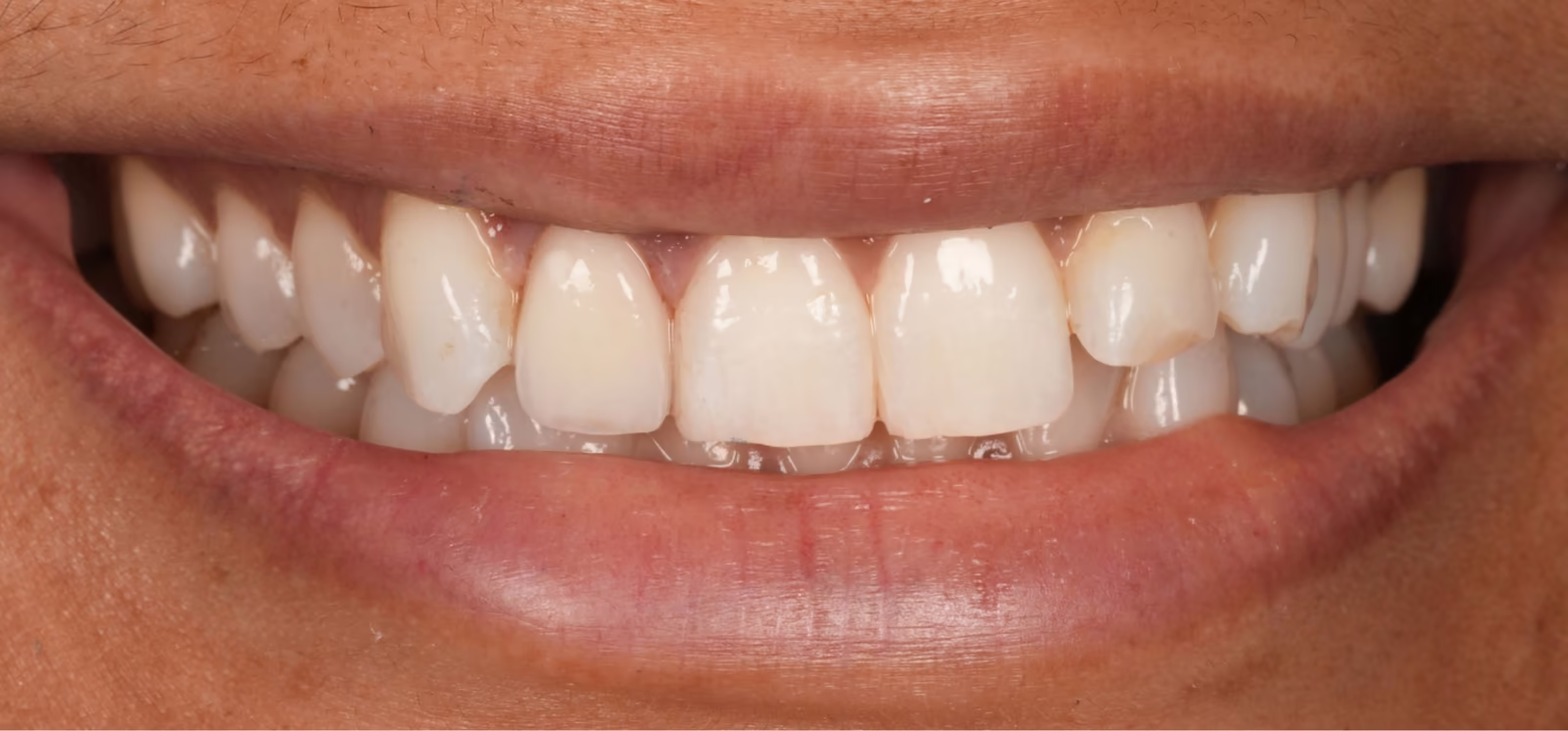 Close-up smile after replacement of a single front tooth crown, matched to the natural teeth.