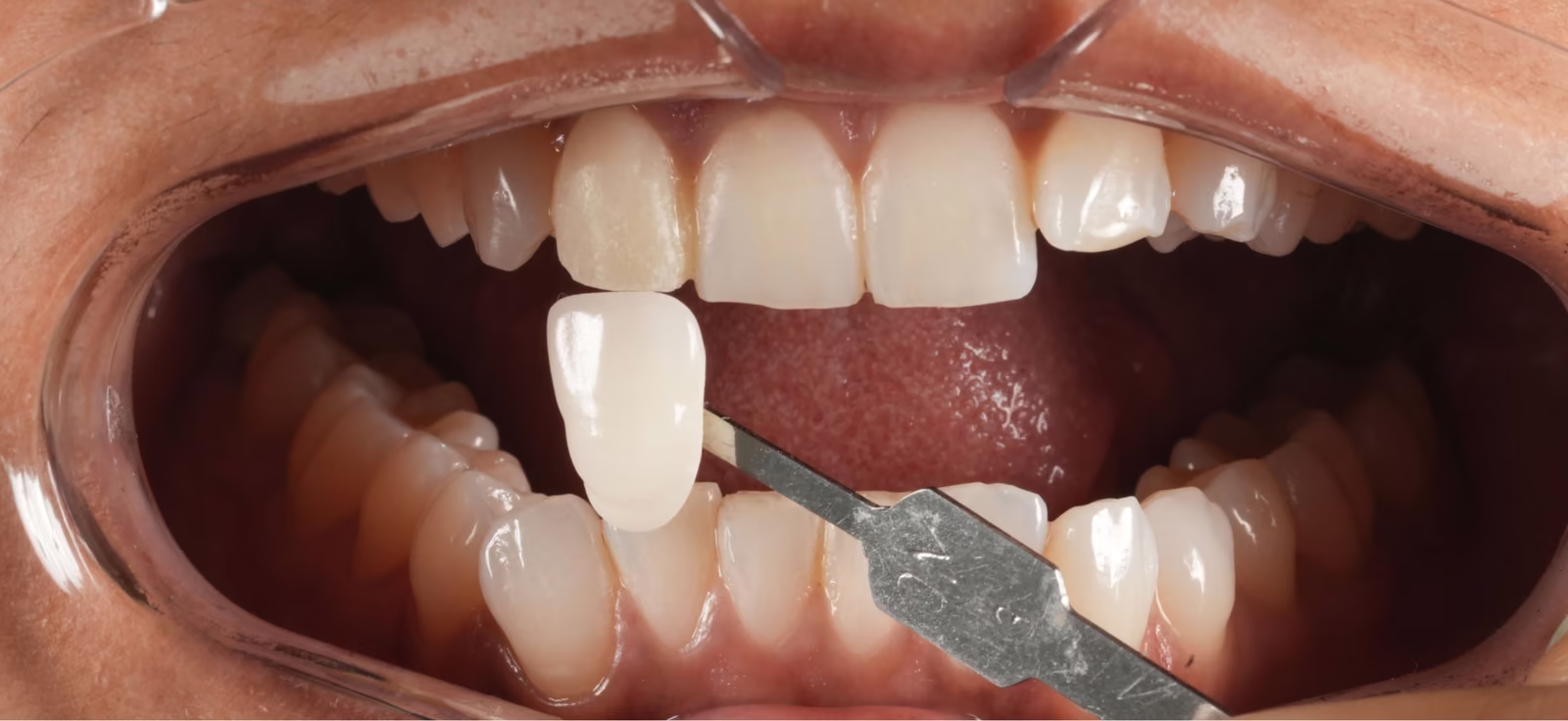 Dental shade guide tab held next to the upper front teeth during shade selection.