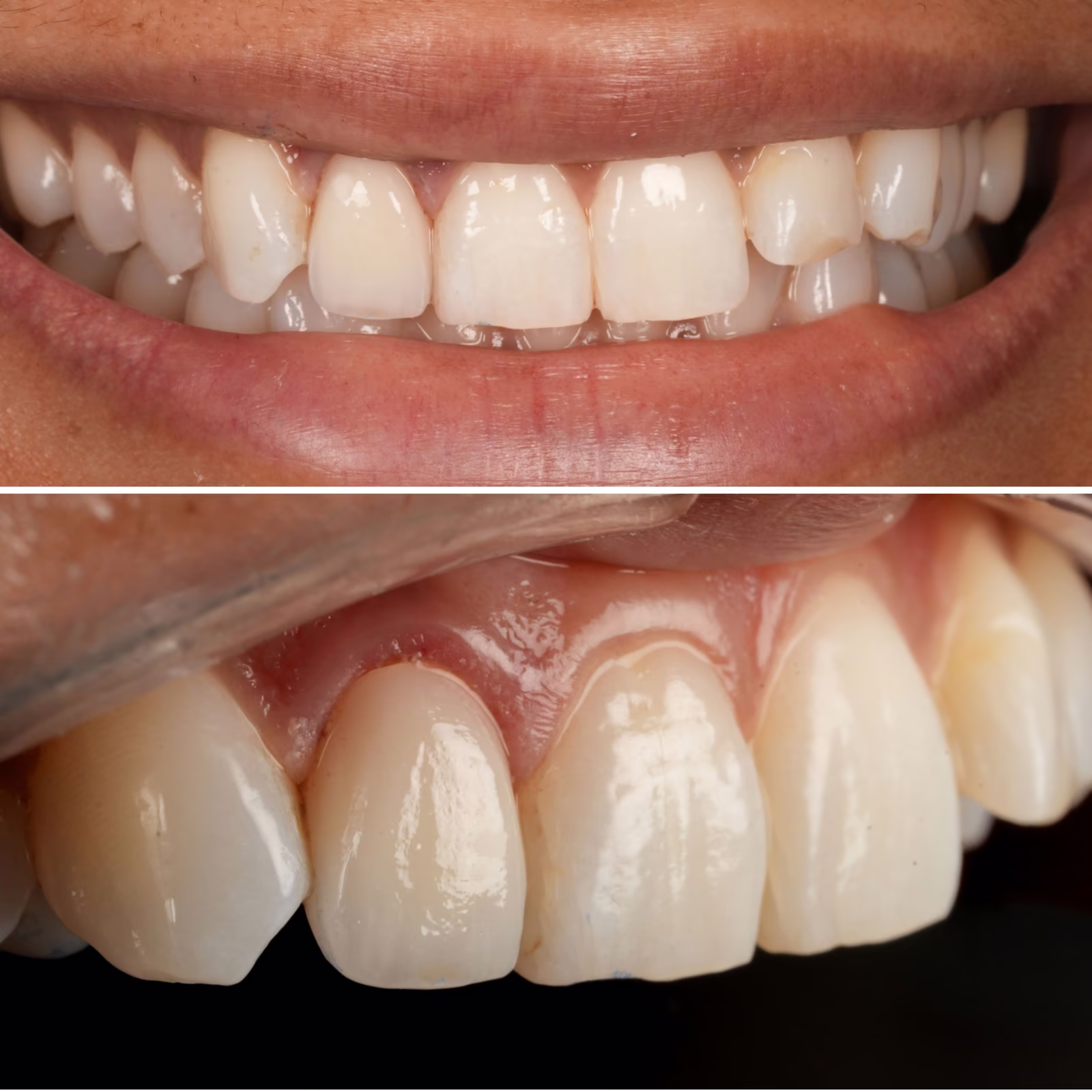 Smile view and retracted close-up of the completed lateral incisor crown after treatment.