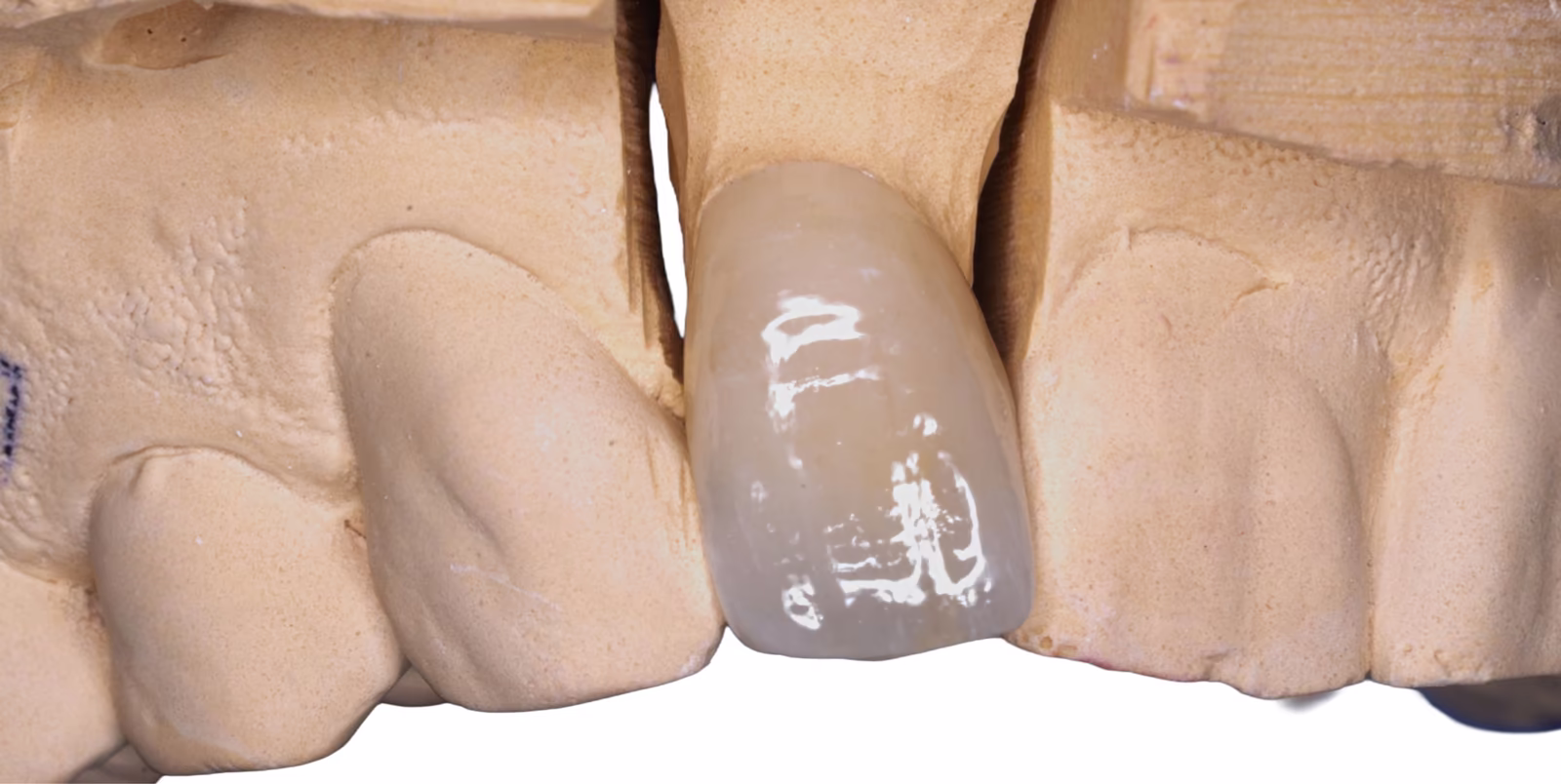 Close-up of the completed layered zirconia crown on a laboratory model.