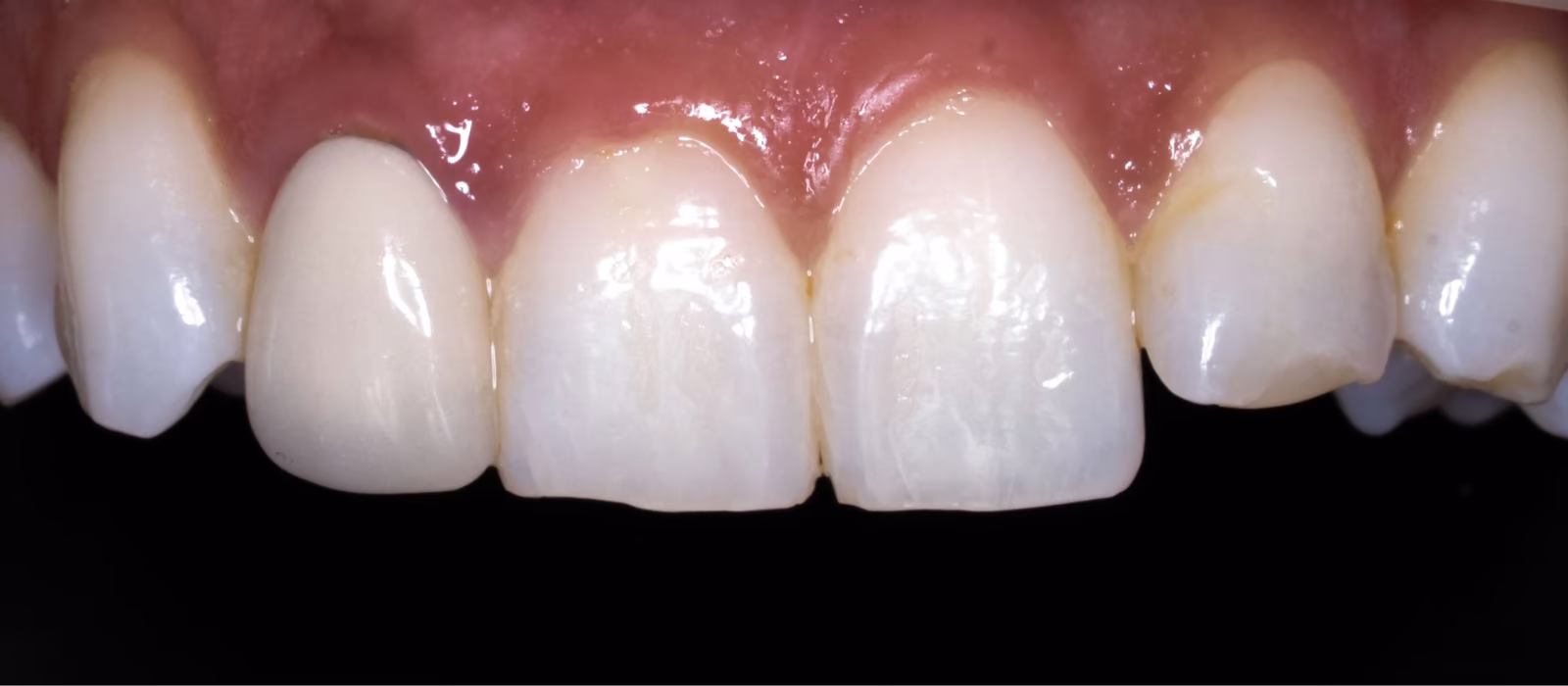 Retracted close-up photograph of the upper anterior teeth before crown replacement.