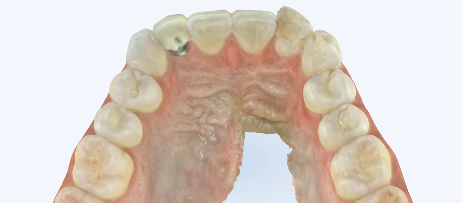 Occlusal view of the upper dental arch showing wear and breakdown on the tongue-facing surface of the crowned lateral incisor.