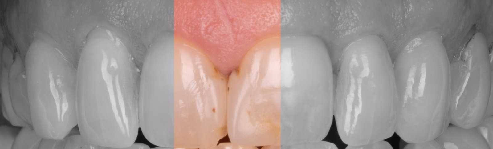 Black and white close-up of failing front tooth bonding showing marginal leakage and breakdown
