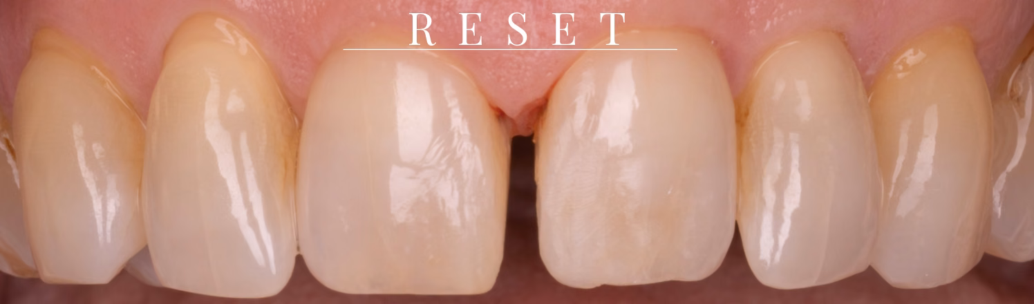 Front teeth after the old bonding was removed, cleaned and ready for new composite