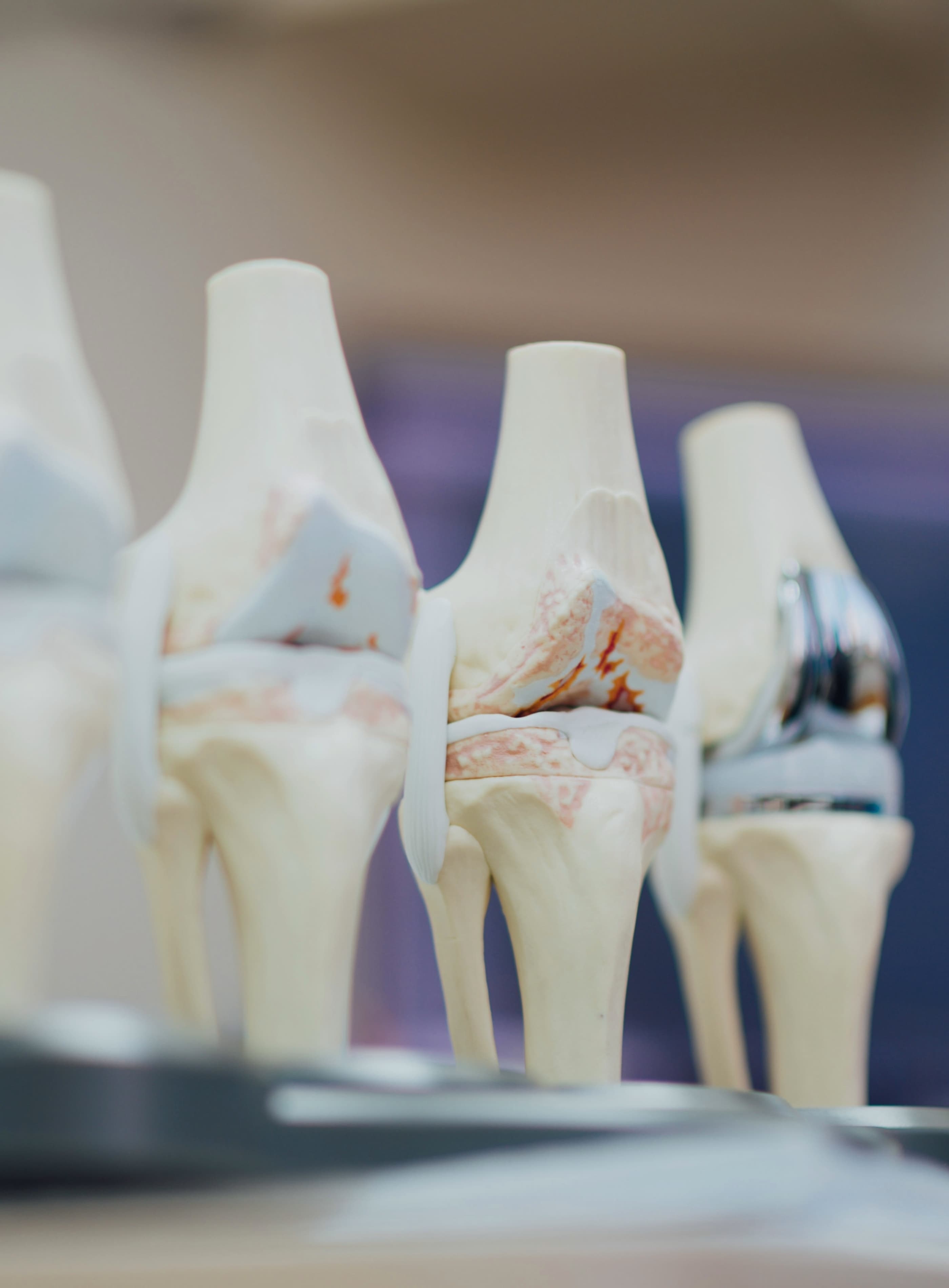 A close up image of 4 knee models with varying types of treatments. including knee replacement.