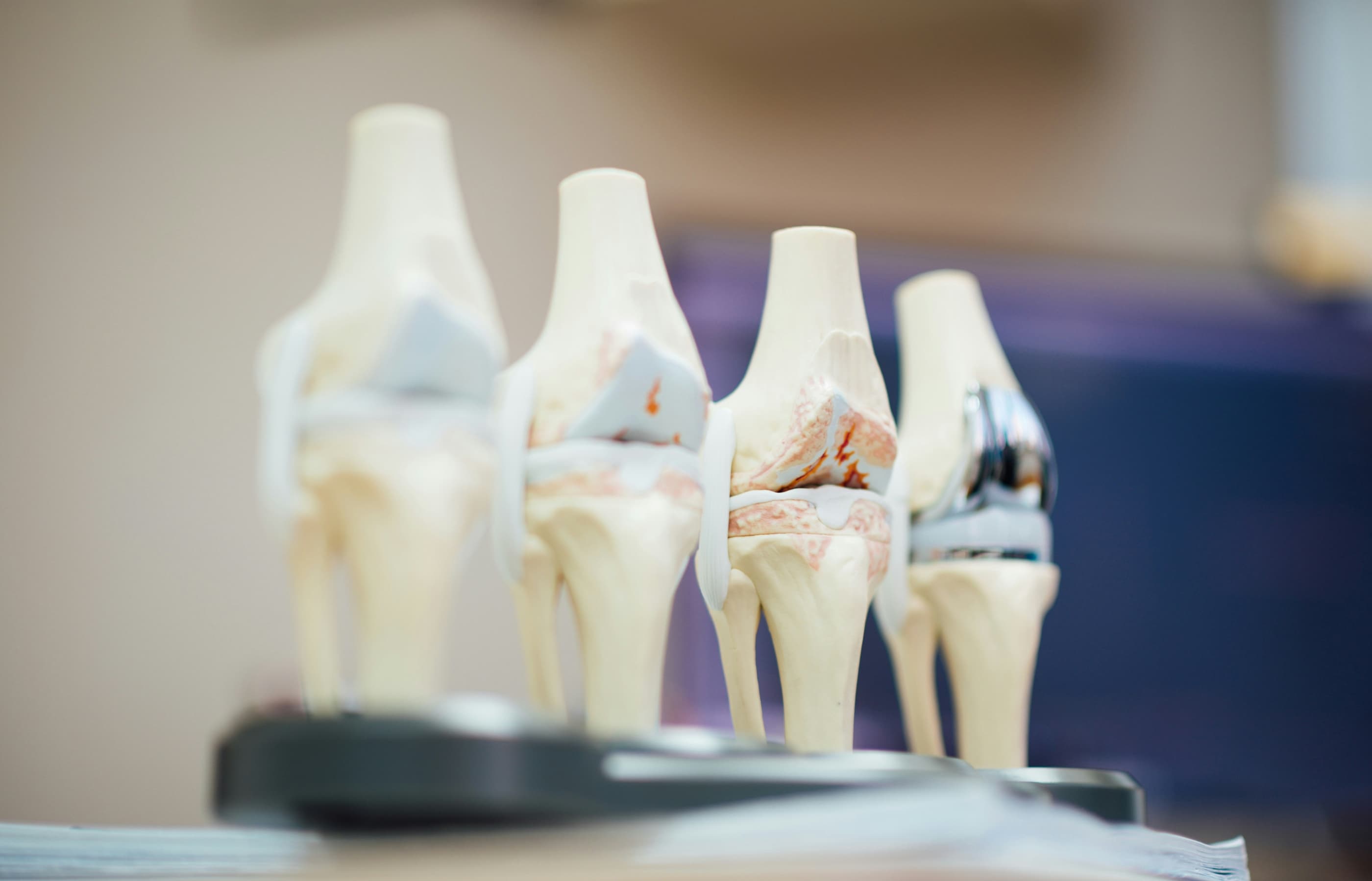 4 models of knee joints with varying stages of wear and tear and knee replacement