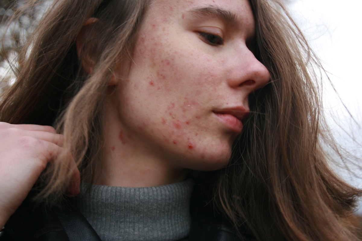 Is skin resurfacing safe for sensitive skin?