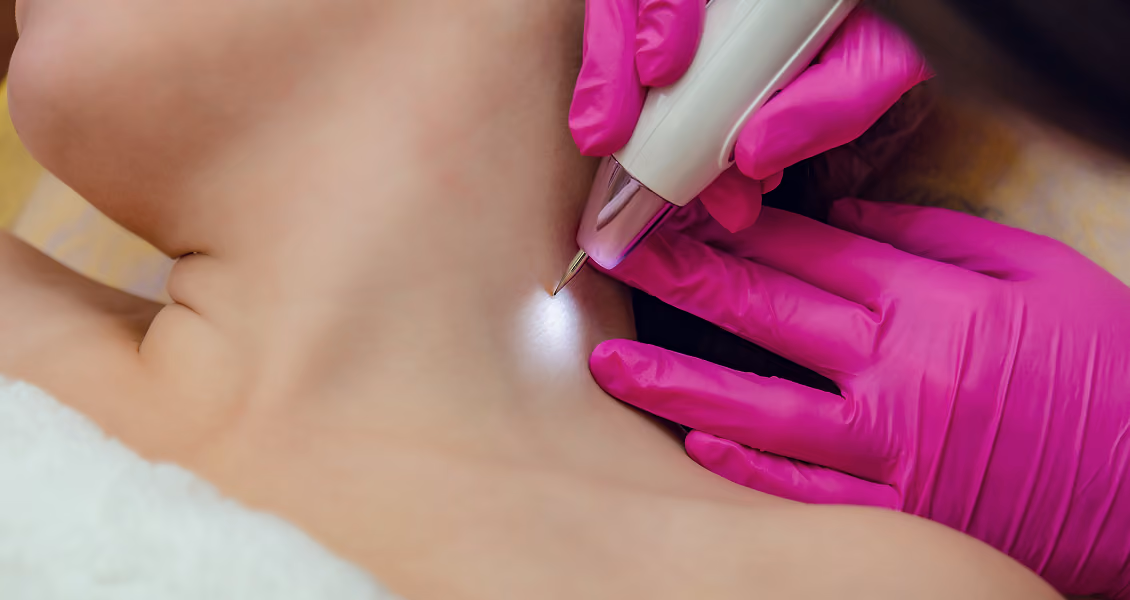 Skin tag removal at Body Blu