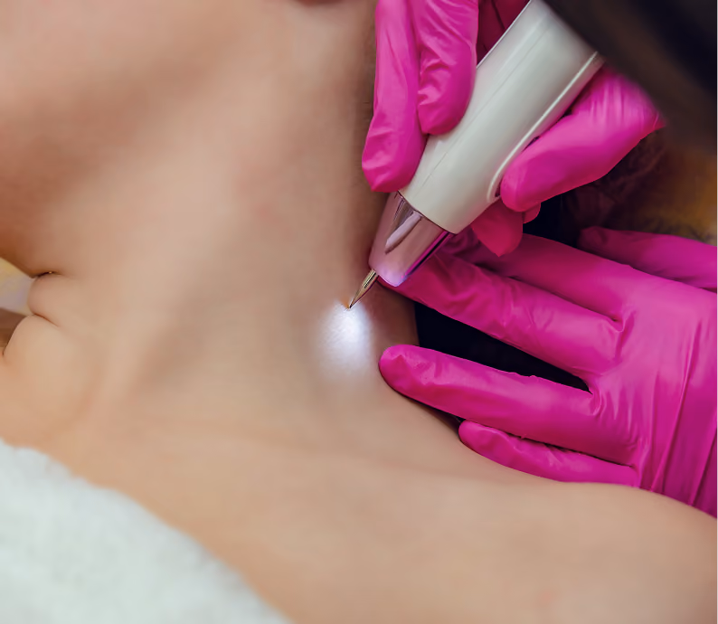 Skin tag removal at Body Blu in Cardiff, CA