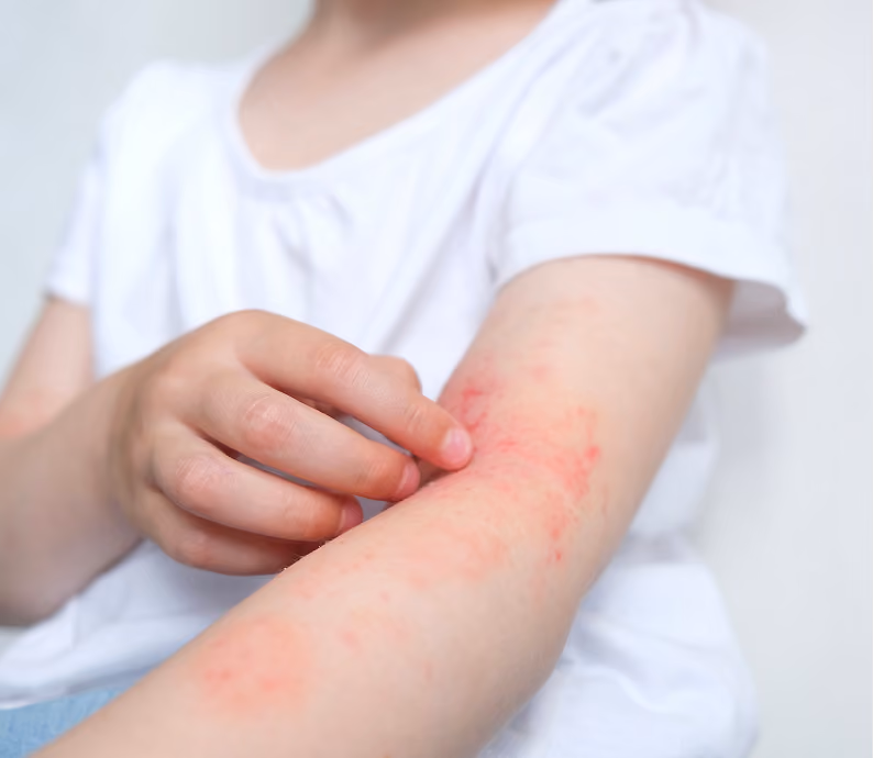 Naturopathic support for eczema at Body Blu