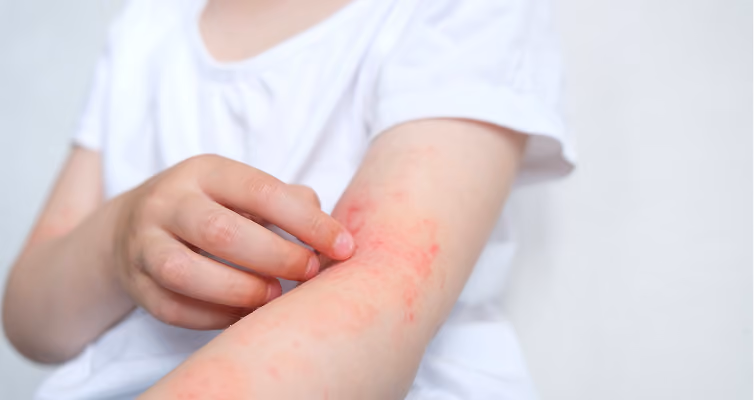 Naturopathic care for eczema and chronic skin conditions at Body Blu