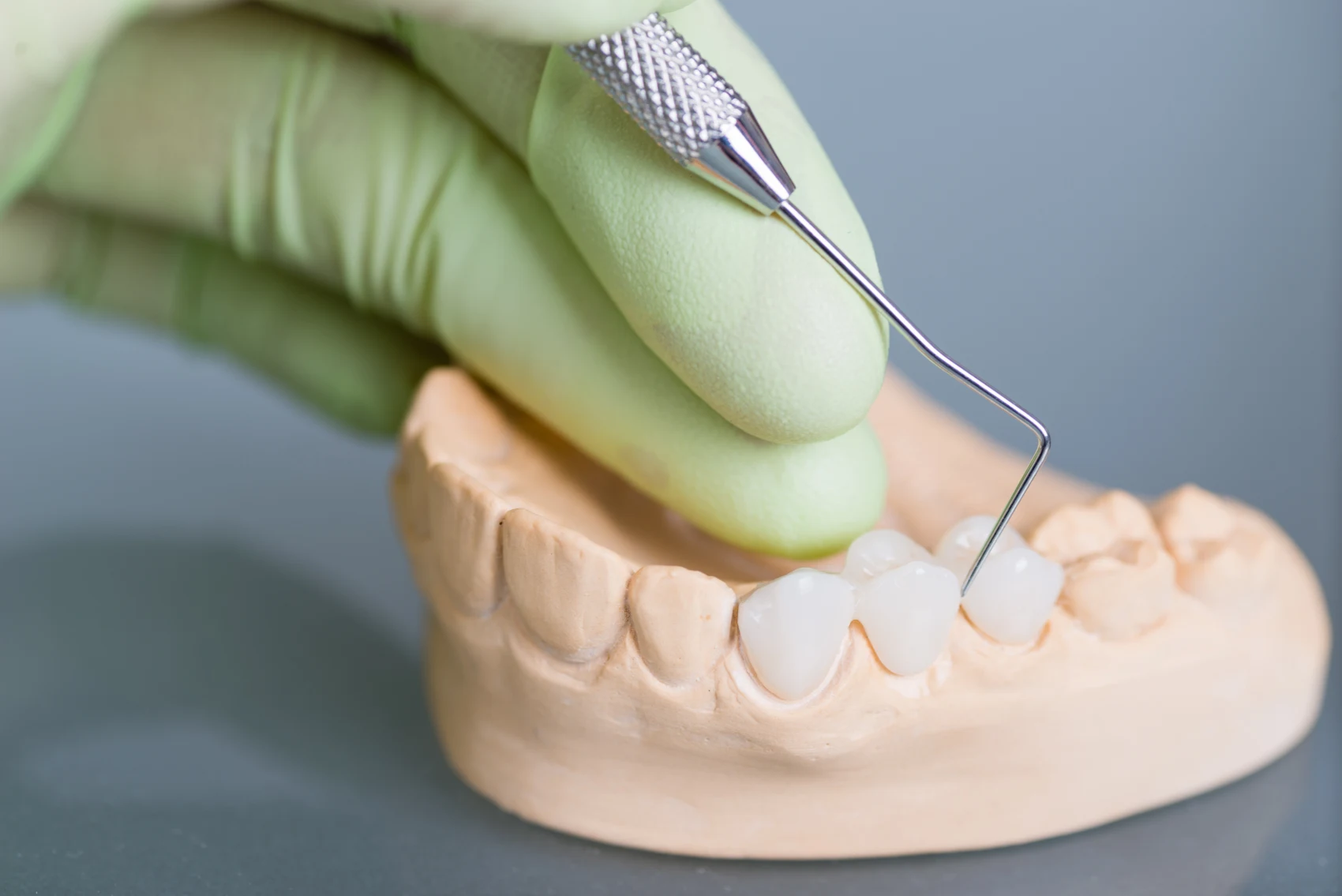 Dental Crowns in Branson, Nixa & Springfield, MO