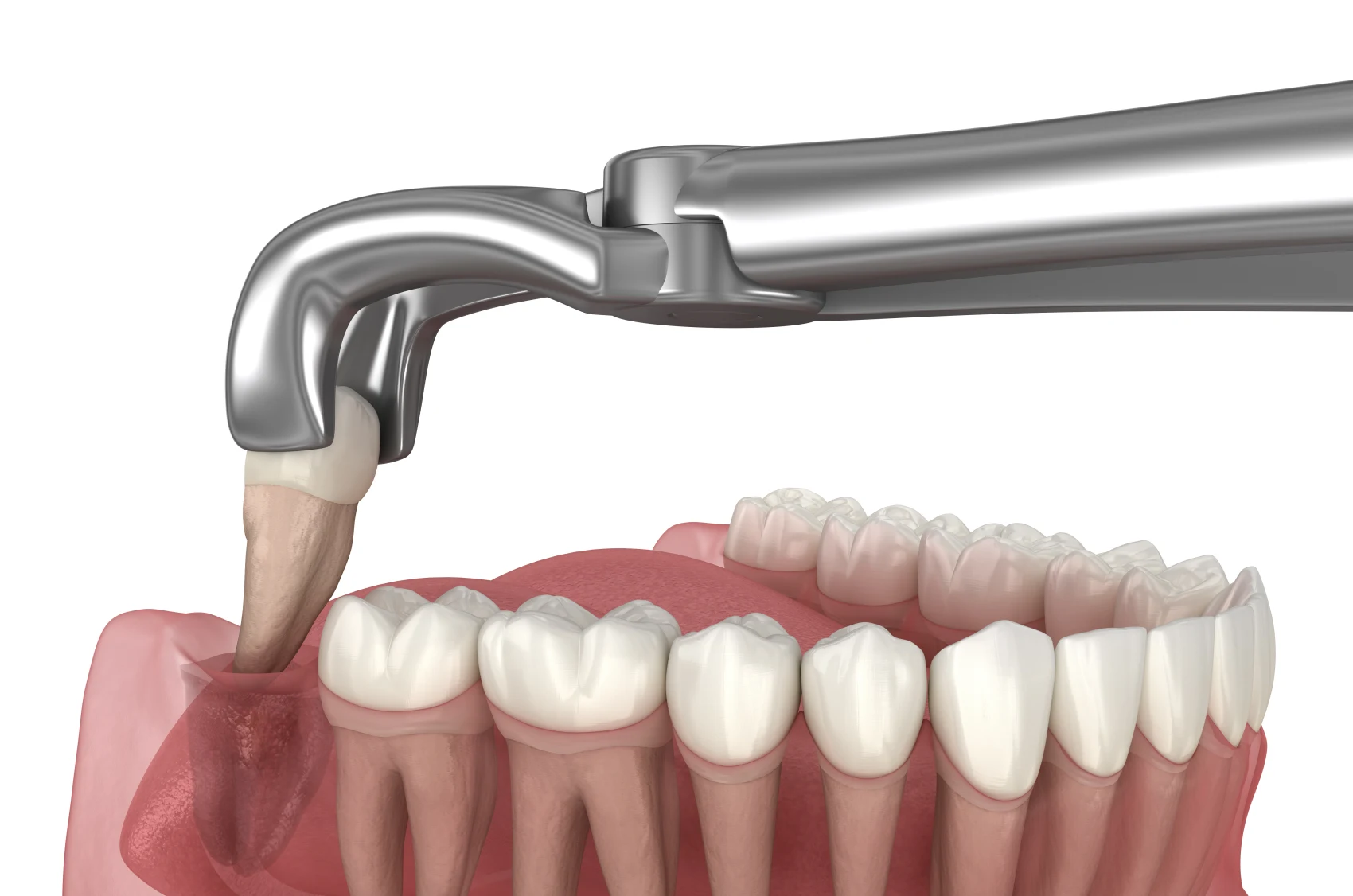 Tooth Extraction
