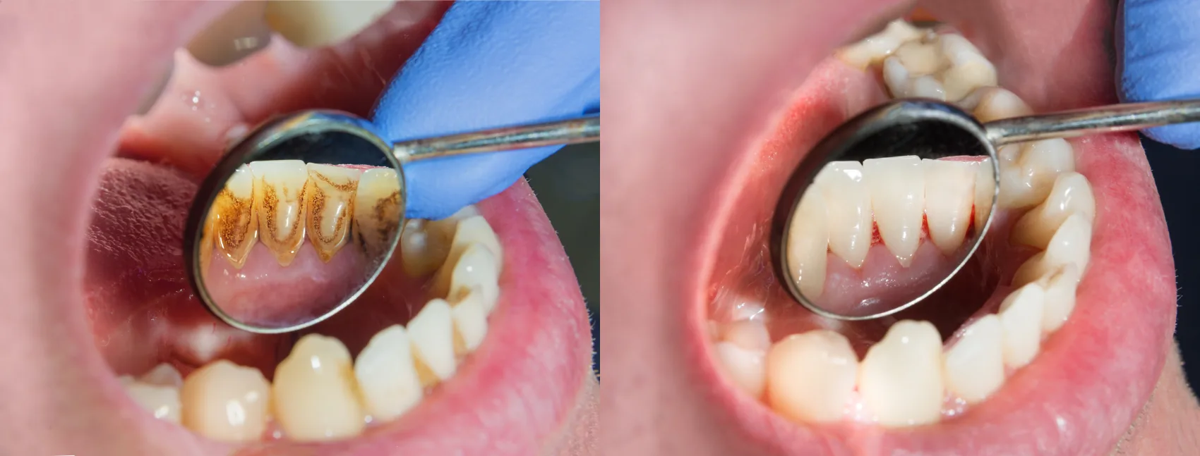 Periodontal Care