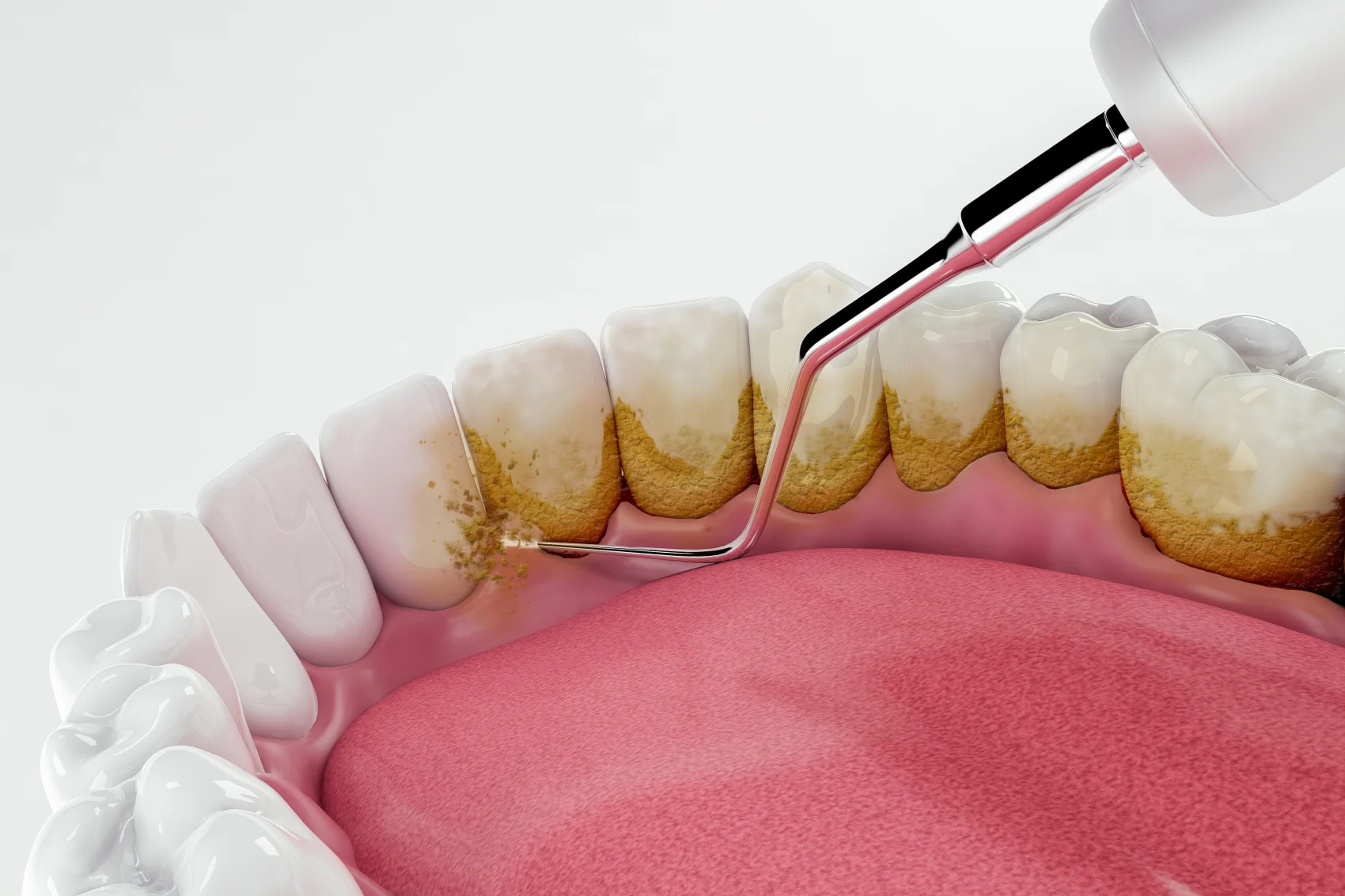 Periodontal Care in Branson, Nixa & Springfield, MO