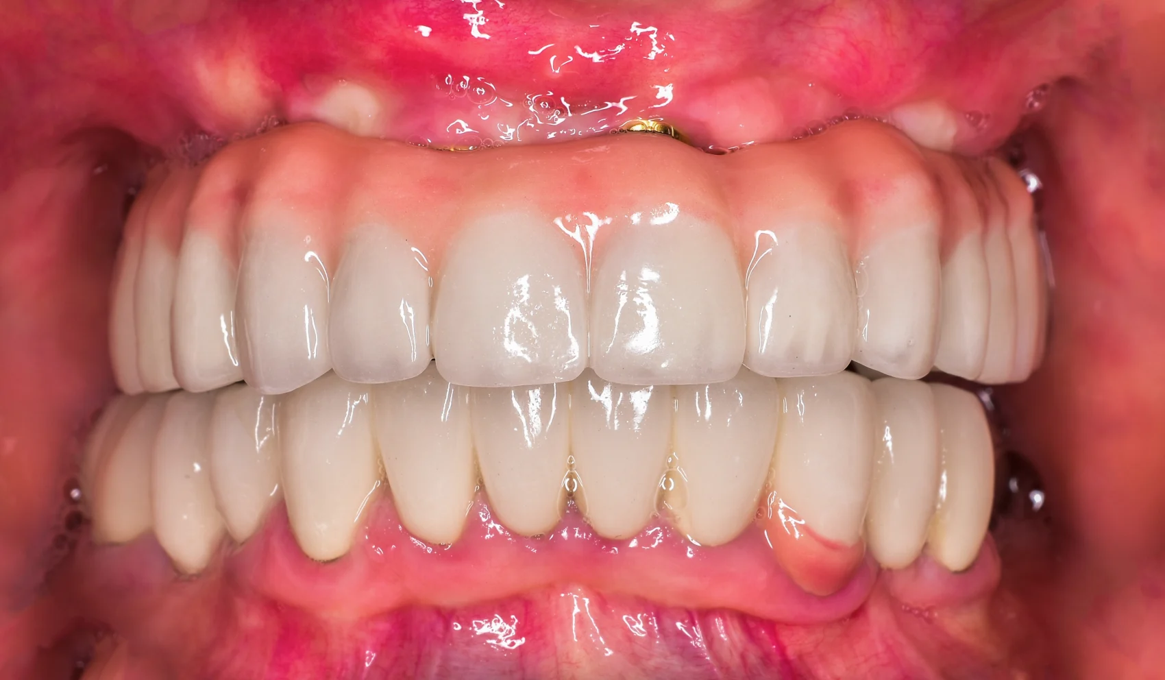 Branson, Nixa & Springfield, MO Full Arch Implants