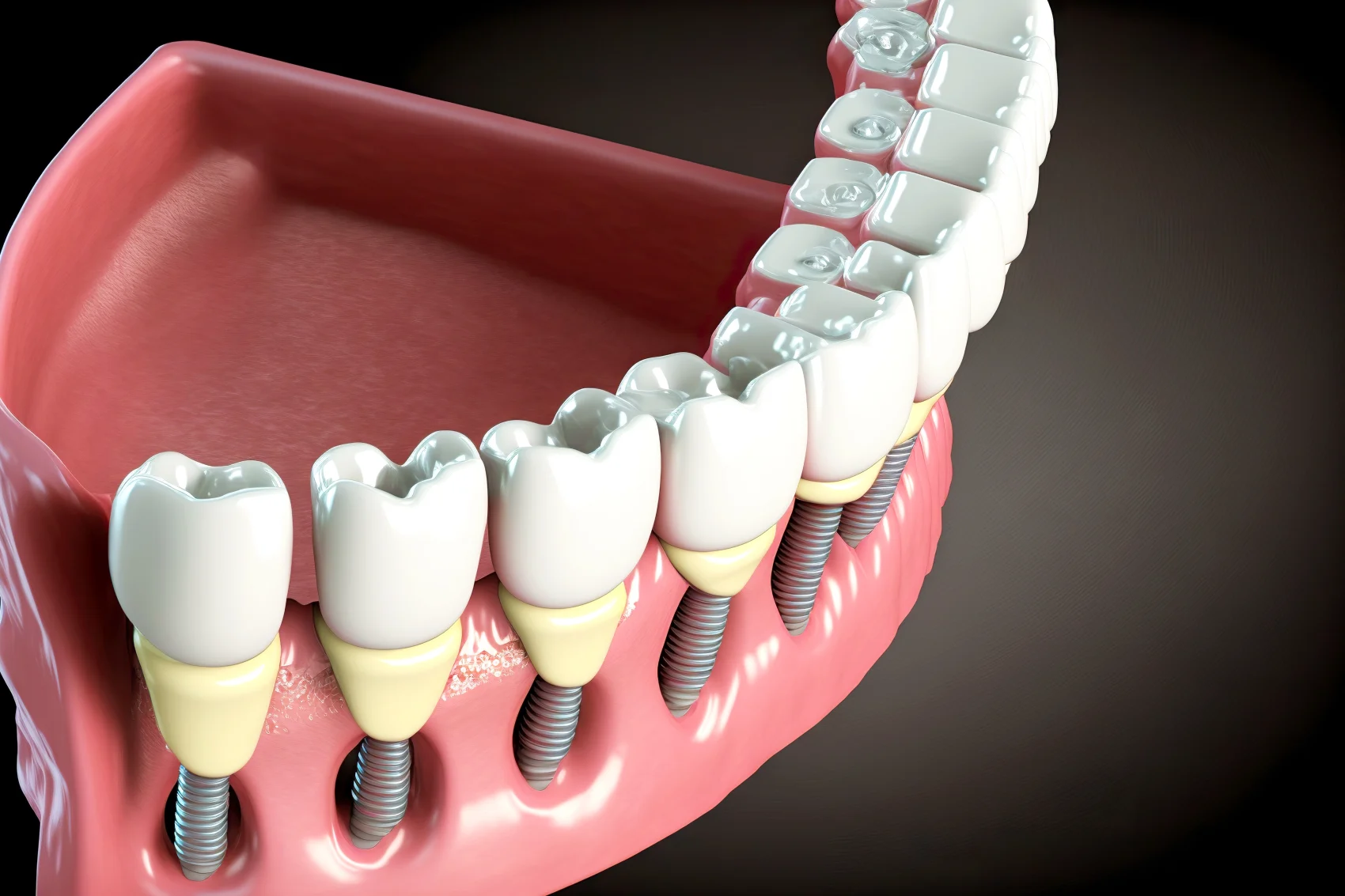 Full Arch Implants in Branson, Nixa & Springfield, MO