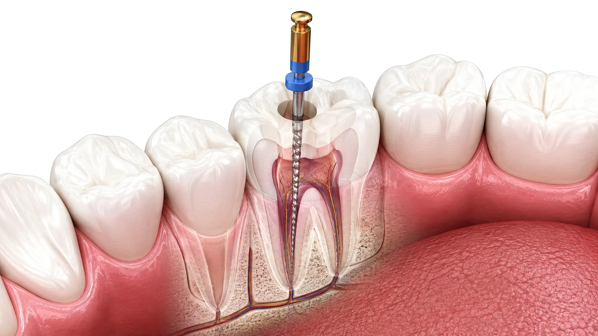 Root Canal Therapy in Springfield, MO | Express Dental Studio