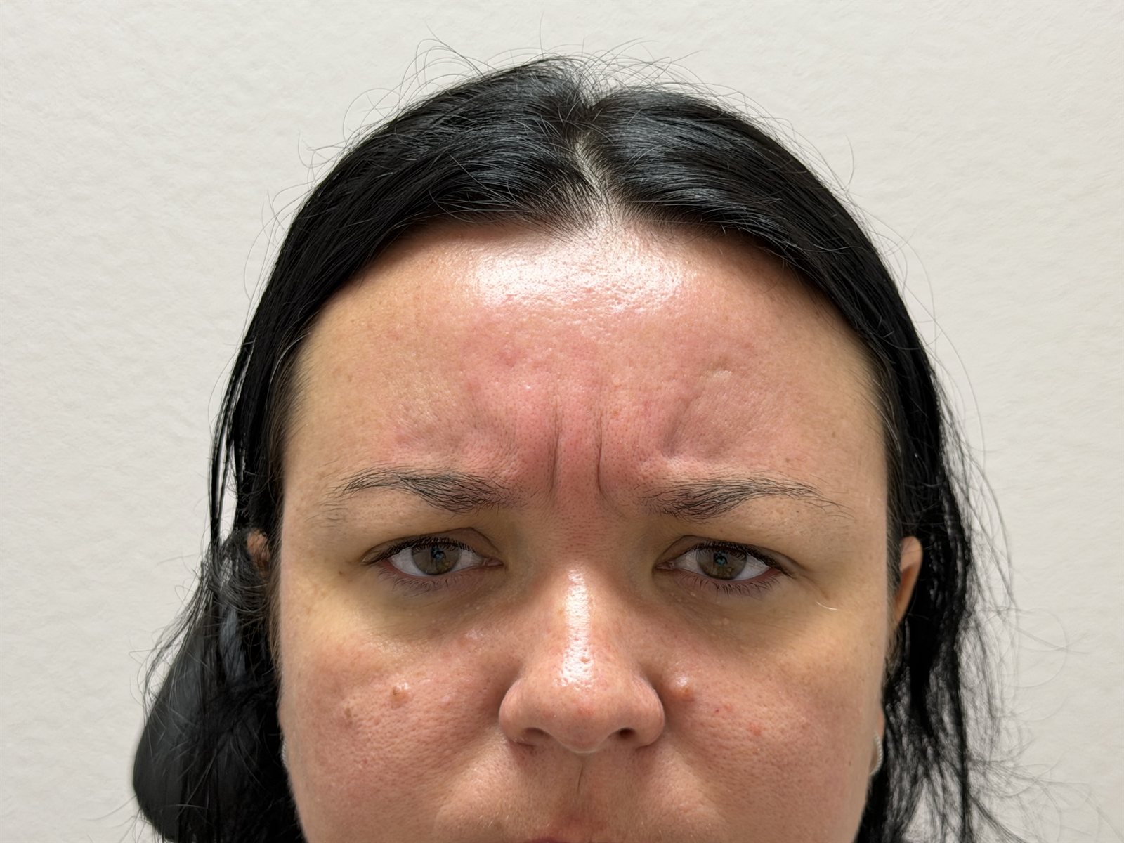 Before Botox — Forehead & Frown Lines at Aurora Medical Spa